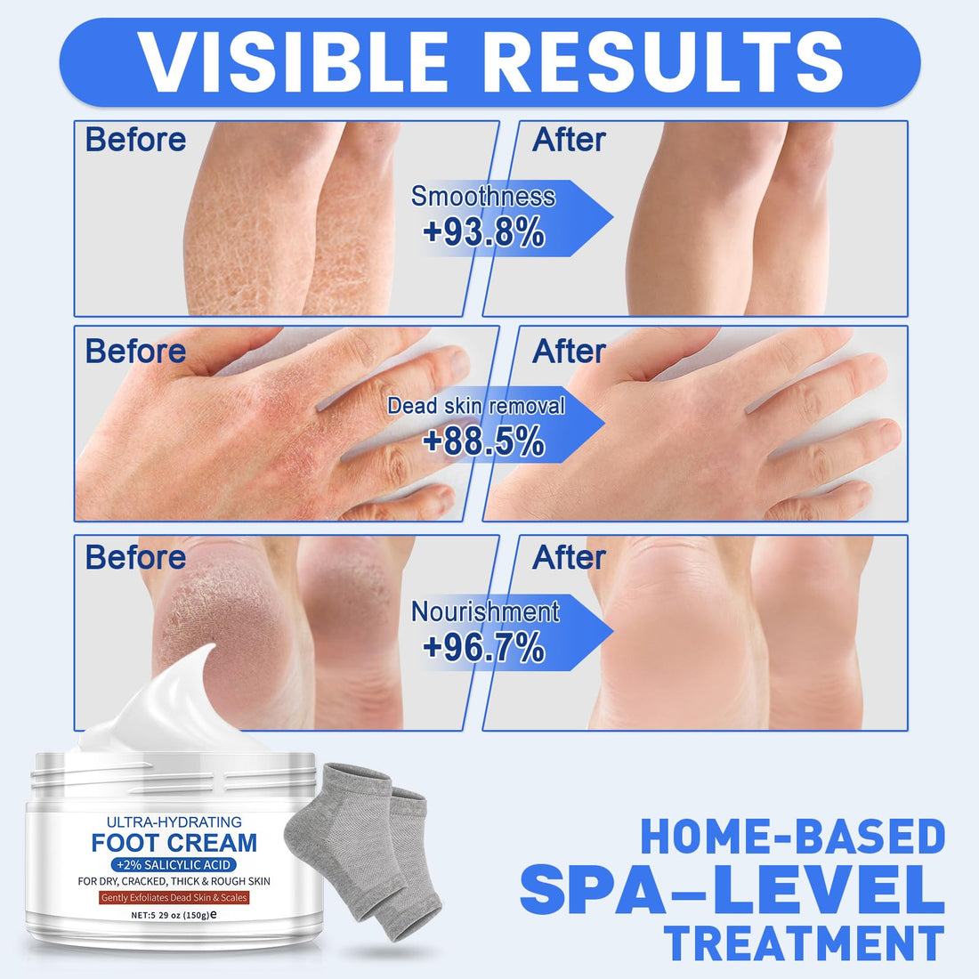 TEAWOO Ultra-Hydrating Foot Cream (Urea Conc. 40.67%), Foot Cream for Dry Cracked Heels and Feet, Pair with Moisturizing Heel Socks for Cracked Heel Treatment, Heel Socks Included (5.29 OZ/150g)