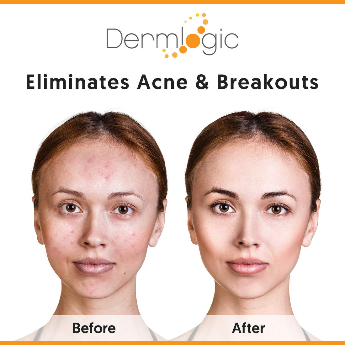Dermlogic Anti-Blemish Control Pads- Contains Salicylic, Glycolic, Lactic Acid For Face & Body. Clears Away Clogged Pores, Oily Skin & Cystic Breakouts. Removes Dark Spots, Blackhead & White