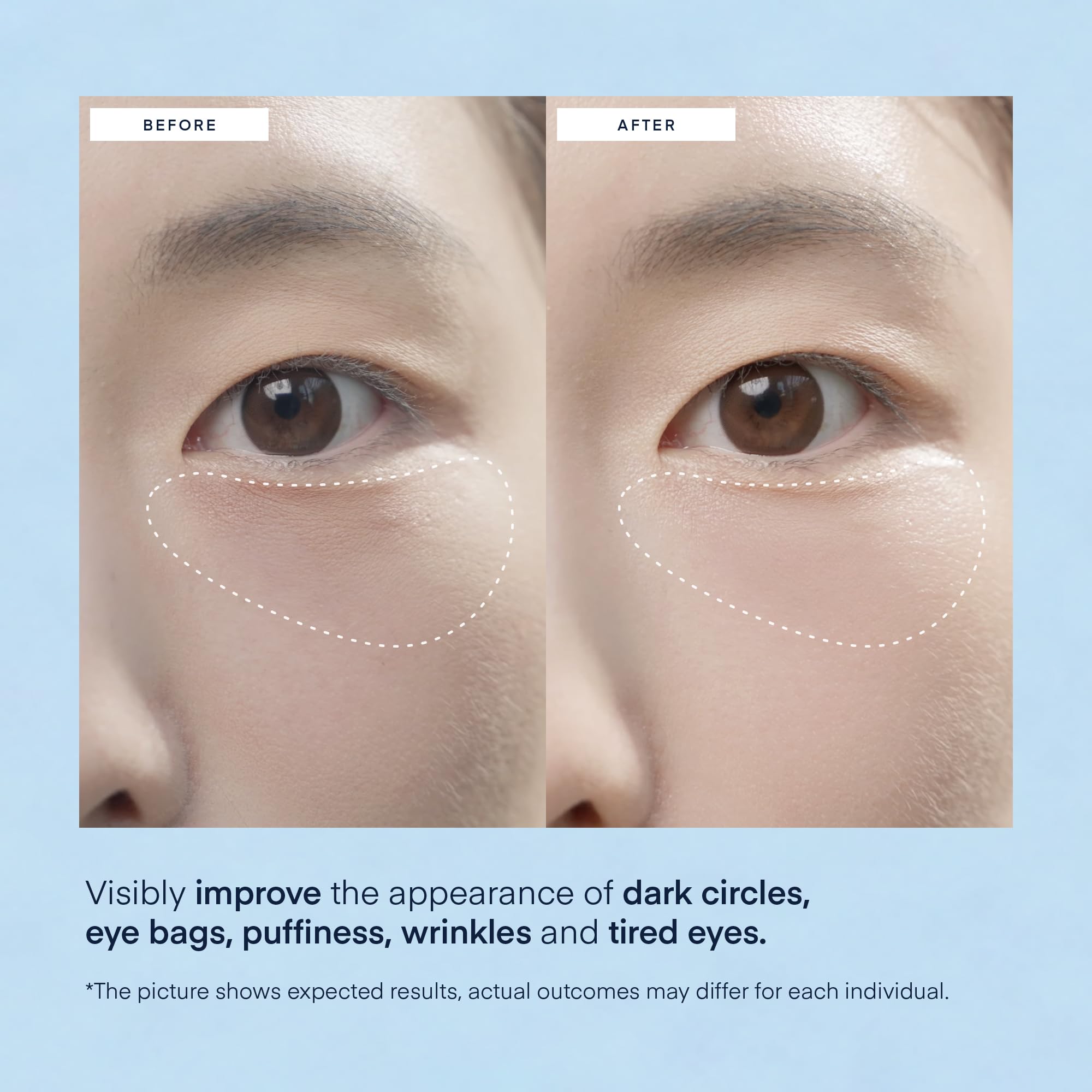 Under Eye Patches for Dark Circles: Puffiness & Eye Bag Treatment Gel Mask with Caffeine Hyaluronic Acid Niacinamide - Undereye Brightening Hydrating Anti-Wrinkle & Cooling - Korean Skincare, 30 Pairs