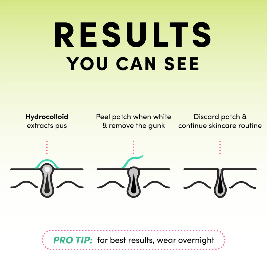 Dots for Spots Pimple Patches For Face - Fast Acting, Translucent Hydrocolloid Zit Patches that Unclog Pores - Korean Skincare - Vegan, Cruelty Free - (60 count)