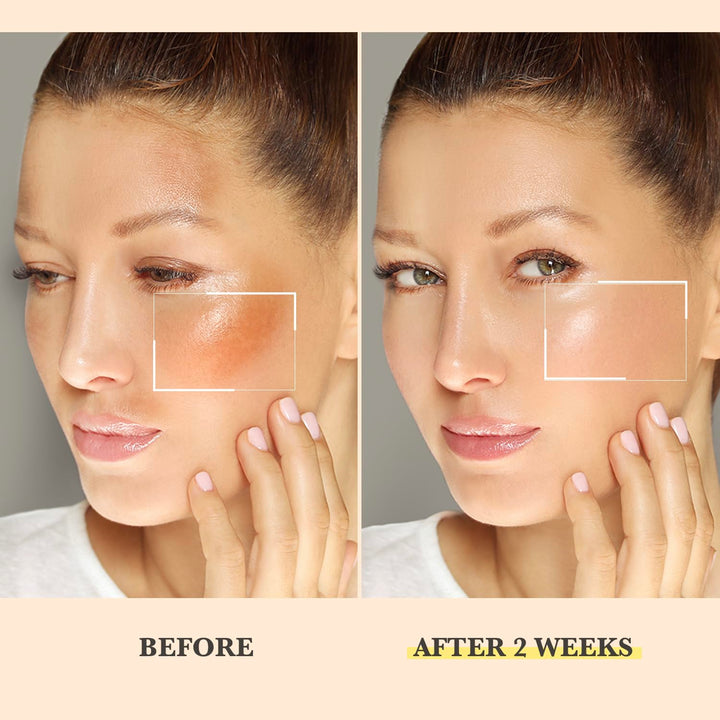 Chemical Peel for Face - Peeling Oil for Facial & Body Exfolianting with 16% Salicylic Acid - Dead Skin Remover with Gentle Formula for All Skin Type - 120 mL