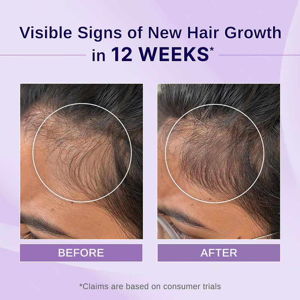 Bare Anatomy Nature x Science Rosemary Hibiscus Hair Growth Oil for Women & Men | Helps Hair Growth & Strengthens Hair | Nourishes Scalp & Controls Hair Fall | Suitable for All Hair Types-100ml