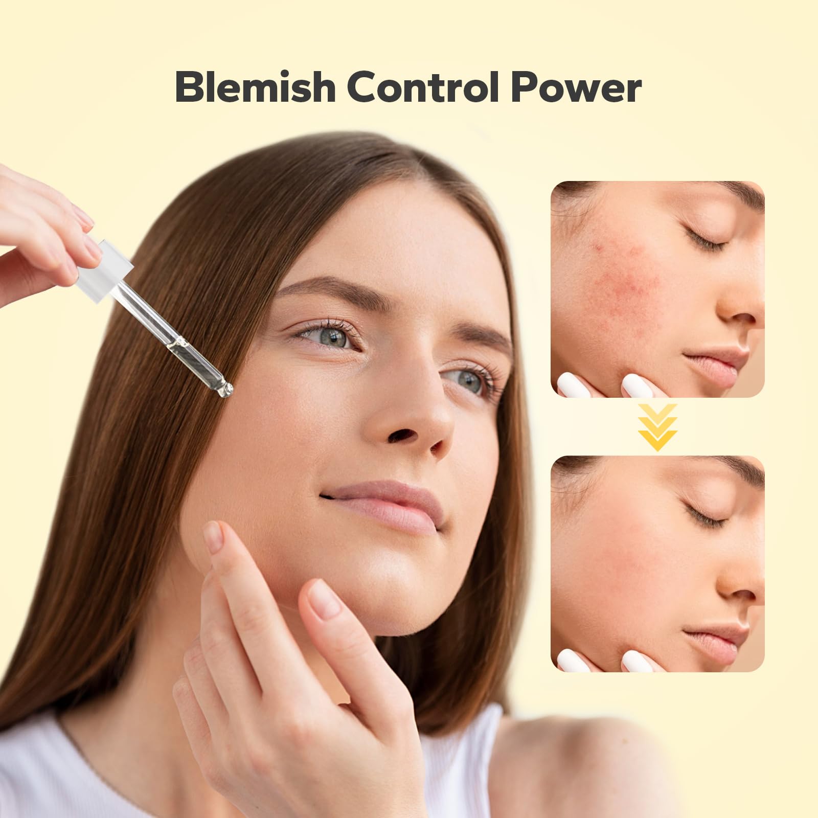 SilkySecret 10% Azelaic Acid Serum (1 Fl Oz), Niacinamide Infused Skin Care for Face, Pore Minimizing, Redness Relief, Reduce Cystic Acne Scar, Blemish Control Serum