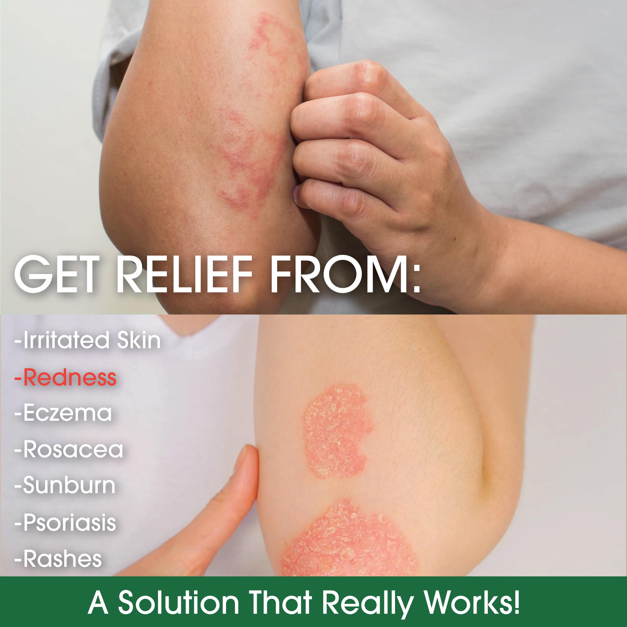 Manuka Honey Eczema Cream Moisturizing Lotion for Psoriasis Relief - Itchy, Dry Skin Rash Ointment - Soothing Moisturizer for Baby, Kids, Adults - High Strength Body & Face Cream 4oz