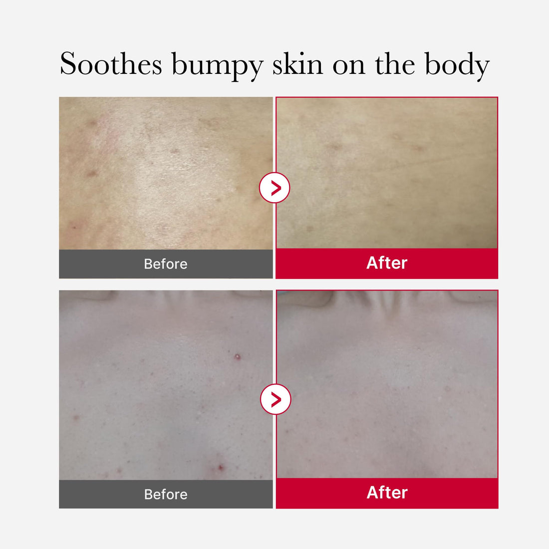 medicube Red Body Peeling Shot, Body Spray Cleanser for Strawberry skin, AHA + BHA + Succinic Acid Helps Reduce Body Breakouts and Bumpy Skin, Smoothing and Exfoliating, 3.88 oz.