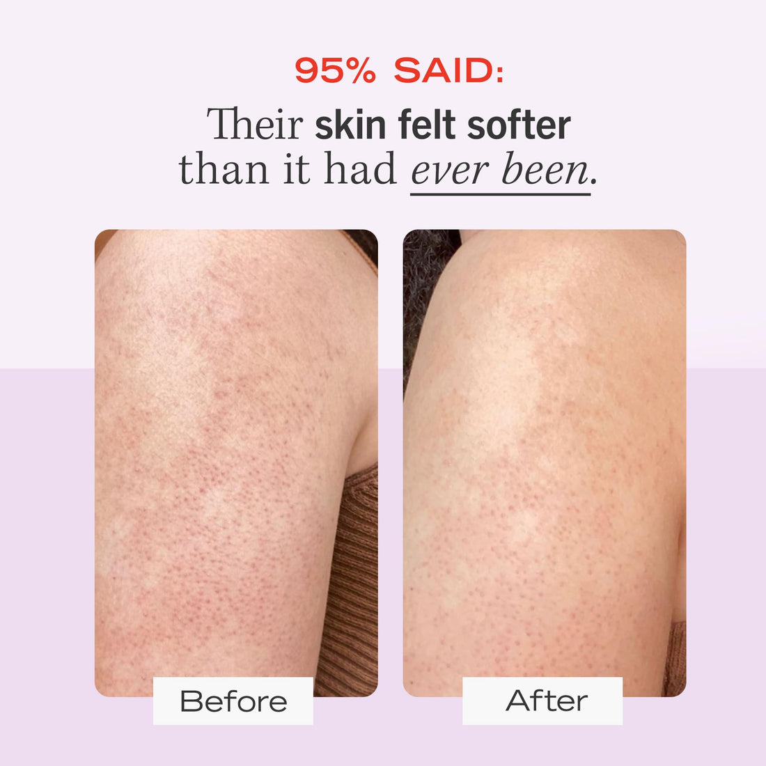 First Aid Beauty - KP Bump Eraser Body Scrub with 10% AHA, Keratosis Pilaris Skin Exfoliater with Glycolic and Lactic acids, Helps Reduce Chicken Skin Bumps, Safe for Sensitive Skin, 8 oz + Bonus, 2ct