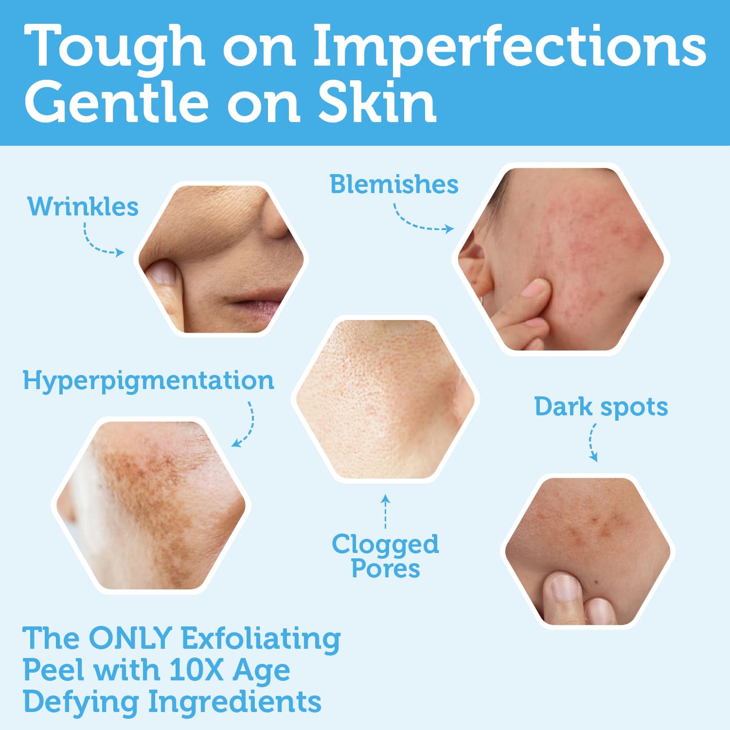 Glycolic Acid Peel AHA BHA Exfoliant - 70% USP Grade Clinical Strength Age-Defying At Home Chemical Exfoliant for Face - Salicylic and Lactic Acid, Aloe Vera, Manuka Honey, Hyaluronic Acid