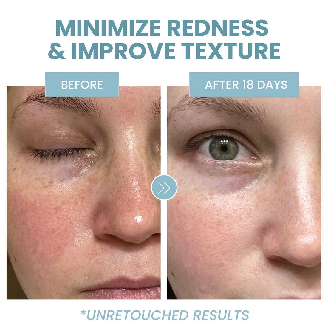 Azelaic Acid 10% Facial Serum, 2 oz., Skin Brightening Hyaluronic Acid and Niacinamide, Redness Relief, Fade and Repair Dark Spots