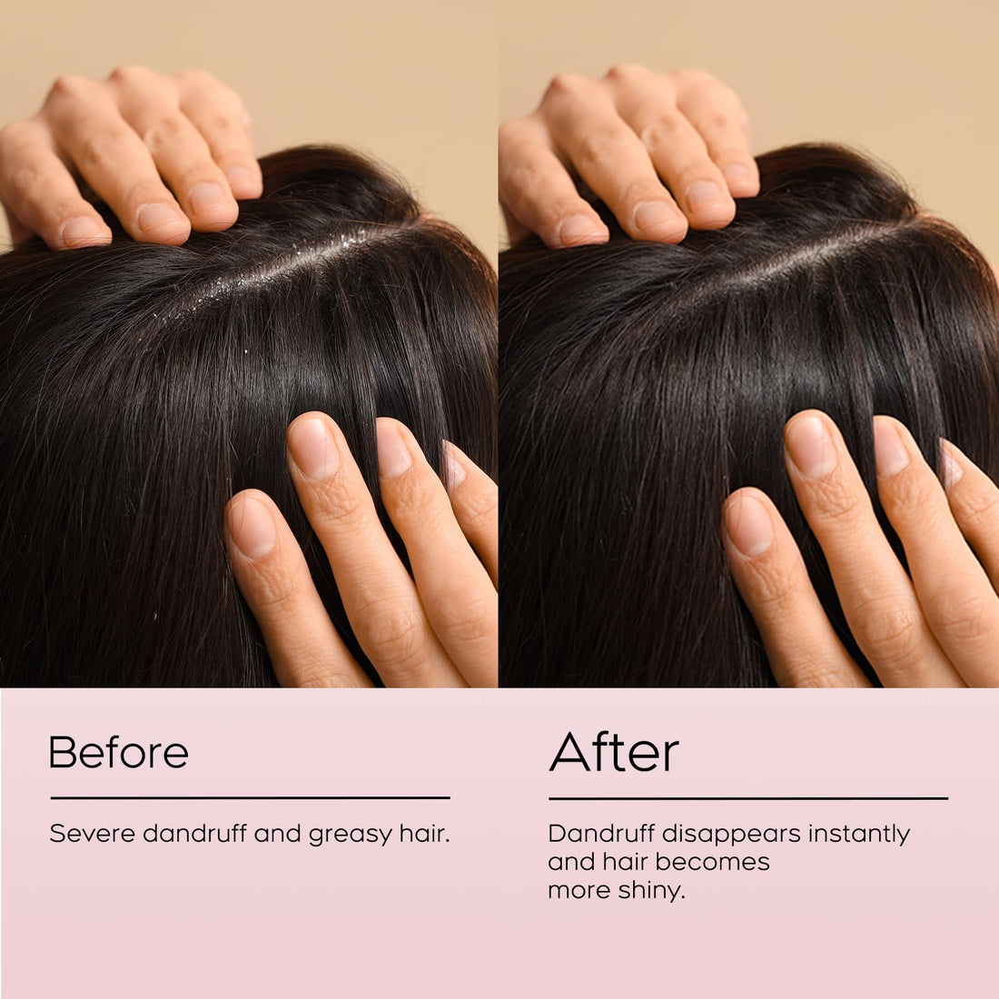 Anti fungal Shampoo for Psoriasis, Seborrheic Dermatitis & Folliculitis - Physician-Formulated Relieves Itchy, Dry Scalp - Sulfate & Paraben Free Anti-Dandruff Shampoo for Men and Women,8.4 fl oz.