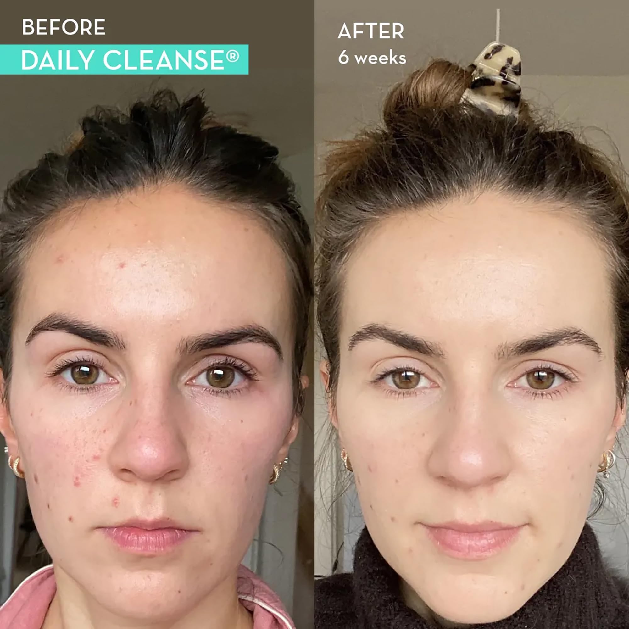 HUM Daily Cleanse Acne Supplements - Support for Clear Skin & Improved Digestion with Chlorella, Spirulina, Organic Algae, Detoxifying Herbs, Vitamins & Minerals - Skin Support for Women and Men