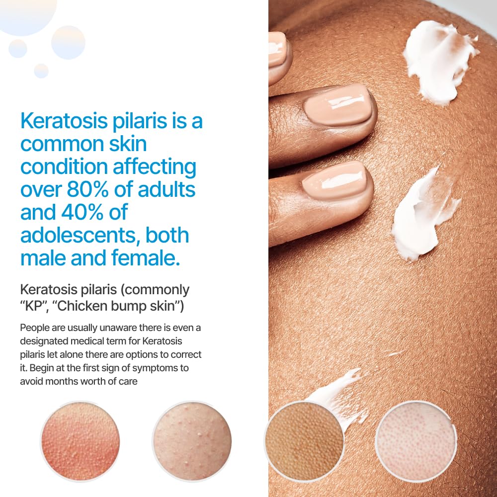 KP Essentials - Keratosis Pilaris Exfoliating Body Wash - Wash Away Red Bumps Caused By KP for Confident Clear Skin, 12oz (2 Bottles) (1 Bottle)