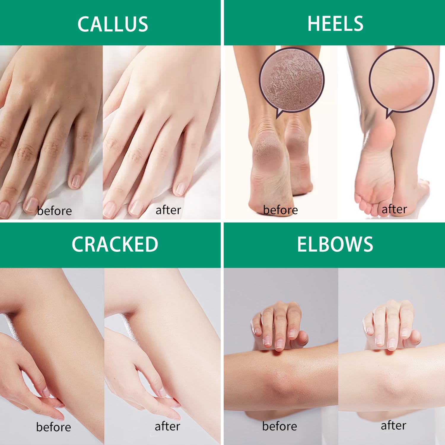 SACLLCAS Urea Cream 40% Plus Salicylic Acid 2% - Fast Absorption, No Strong Odor. Foot Dry and Cracked Foot Cream, Gentle Exfoliating Moisturizing, Suitable for Feet, Hands and Knees