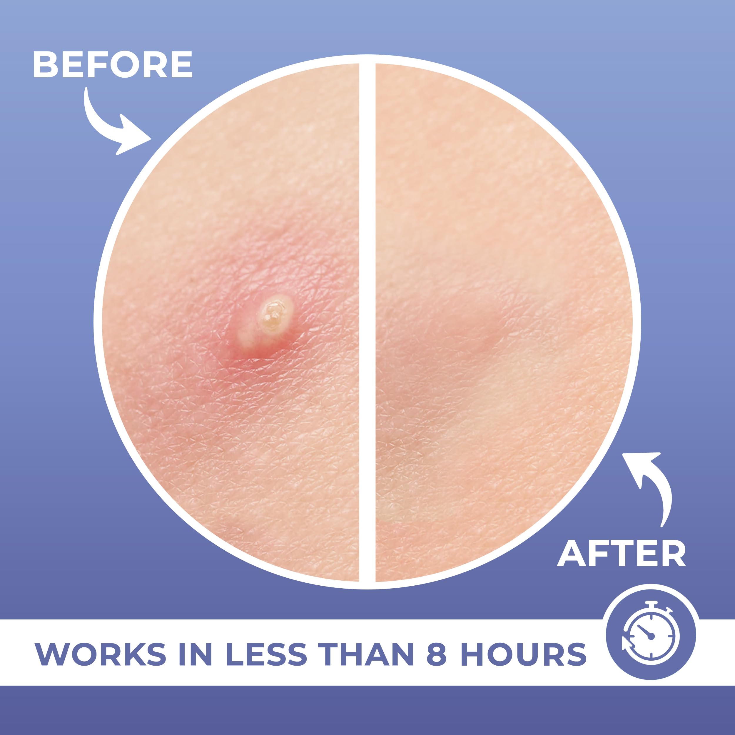 PatchRx Salicylic Pimple Patches (120 Pack), Salicylic Acid Acne Patches with Tea Tree Oil - Zit Patch and Pimple Stickers for Face for Skin Care - Salicylic Acid Acne Dots (Packaging May Vary)