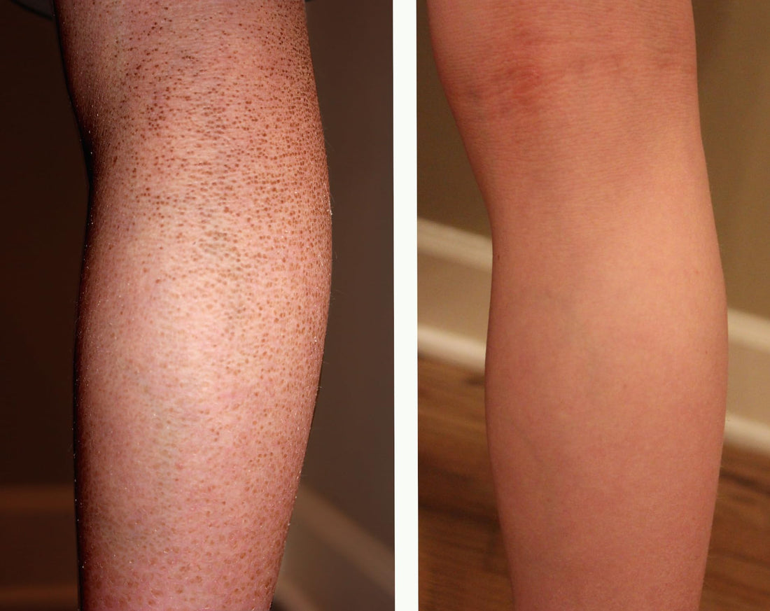 Sr Lotion, Excellent Ichthyosis Treatment, Outstanding Results In 2 Weeks