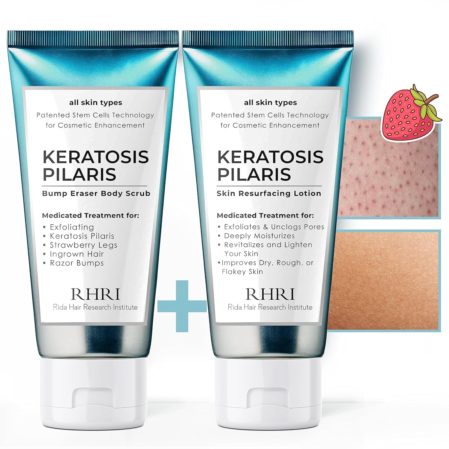 KP Bump Eraser Body Scrub + Keratosis Pilaris Lotion Bundle Set, Strawberry Legs Treatment for Women, Bump Eraser Body Scrub