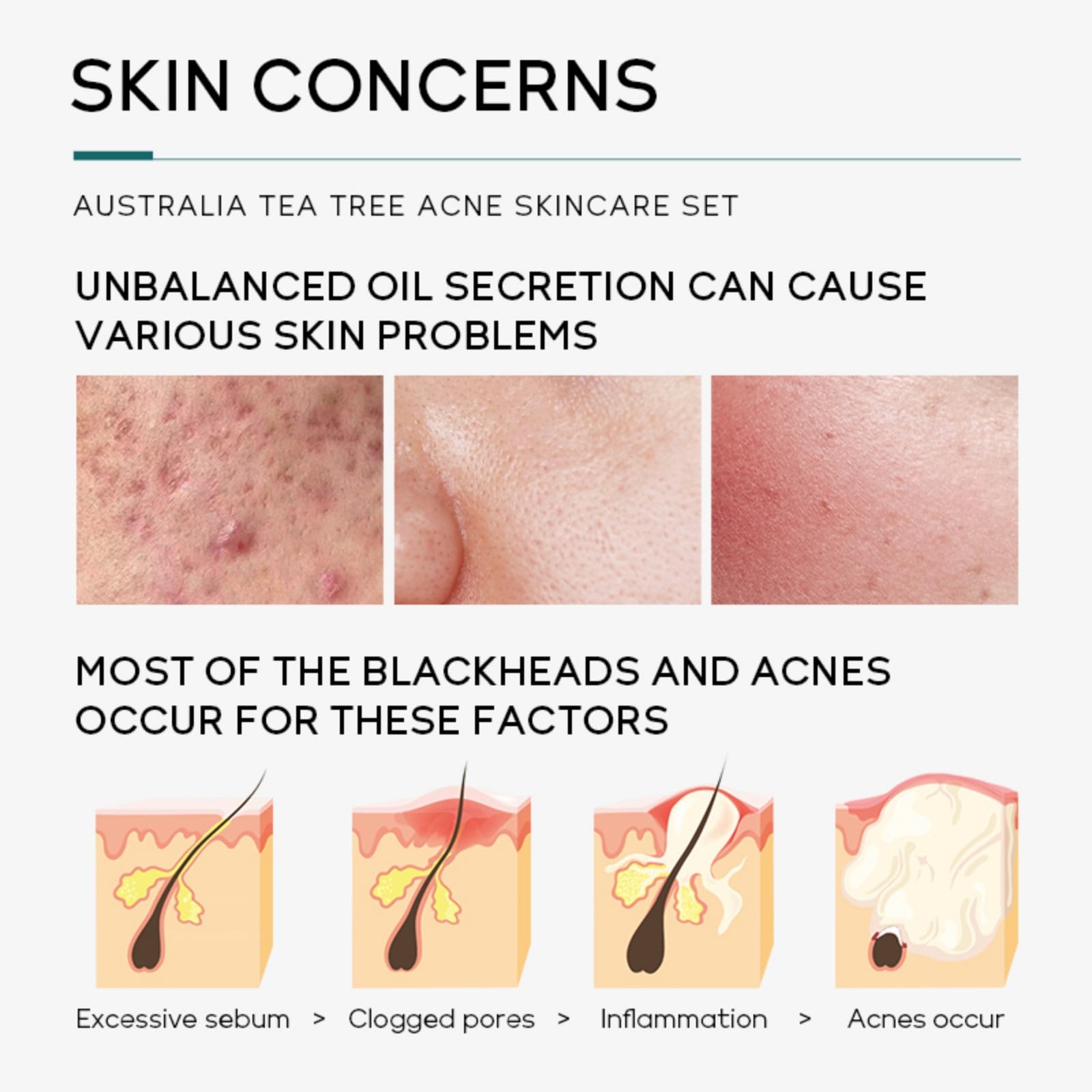 Skin Care Set,Acne Treatment for Face Skin Care Sets & Kits,Tea Tree Essential Oil Facial Skincare Gift Set with Cleanser,Toner,Serum,Gel, Acne Treatment Kit Cream Skin Care for Teens 10-12 Girls Boys