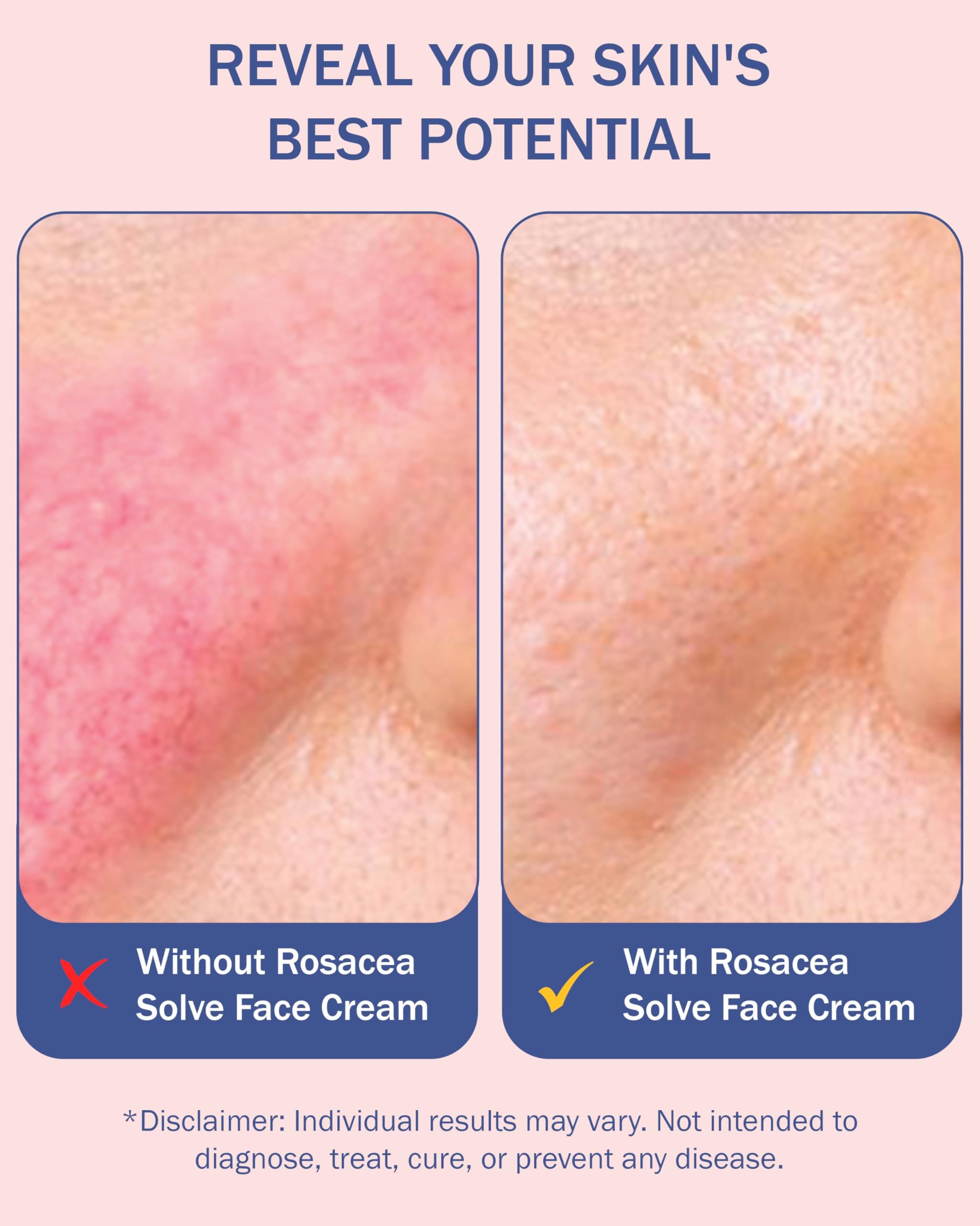 Rosacea Solve Face Serum - Hydrating Serum for Face with 10% Azelaic Acid - Skin Brightening, Pore Minimizer & Redness Corrector for Women & Men by e70, 2 fl. oz