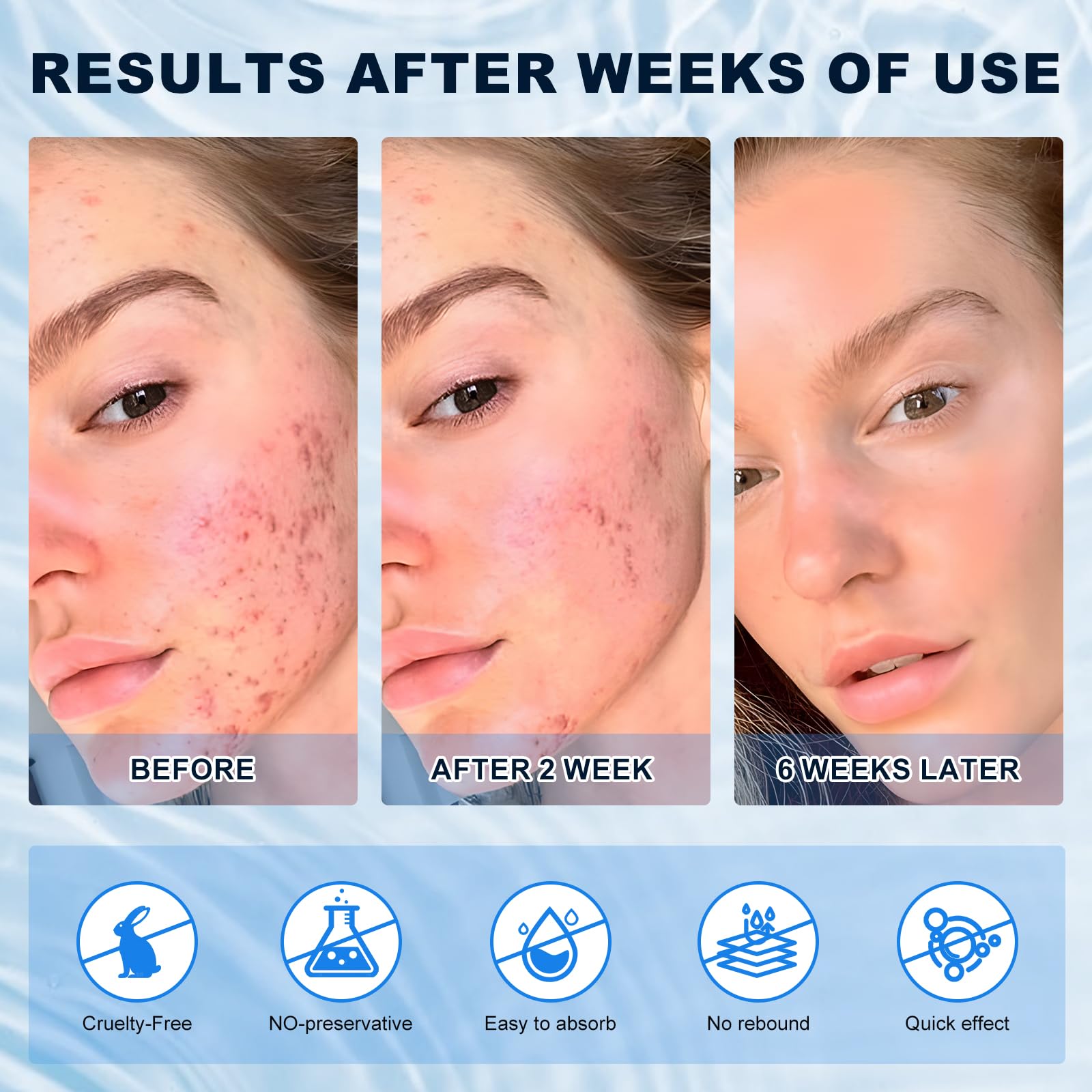 Azelaic Acid 10% Cream for Face - Acne Cream for Rosacea Reducing Relief Pimple Breakouts Blackhead Pigmentation and Redness - Azelaic Acid Gel For Facial and Skin Care