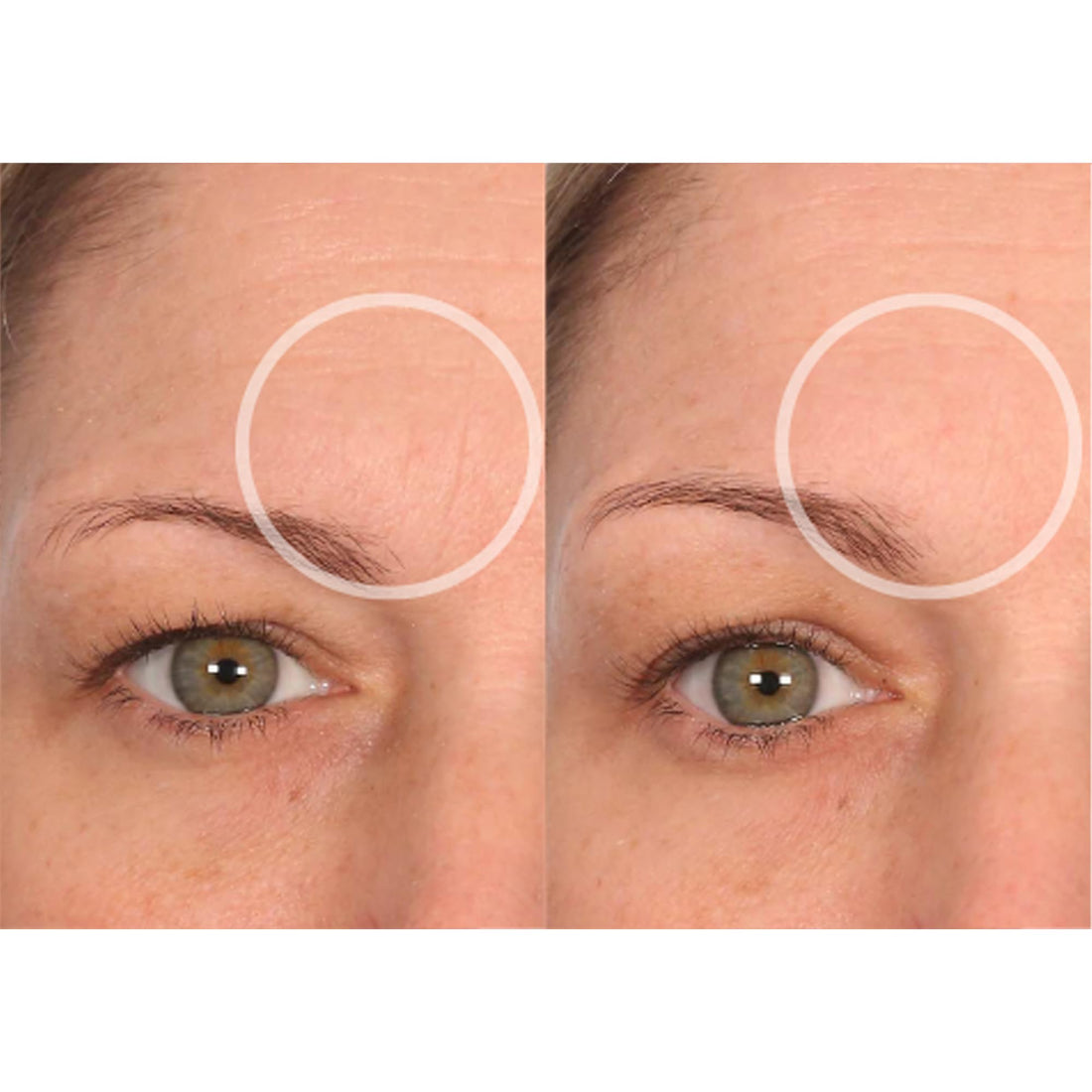 SiO Beauty FaceLift - Reusable Anti-Wrinkle Patches for Neck, Forehead, Eye & Smile - Overnight Smoothing Silicone for Fine Lines, Wrinkles, and Aging