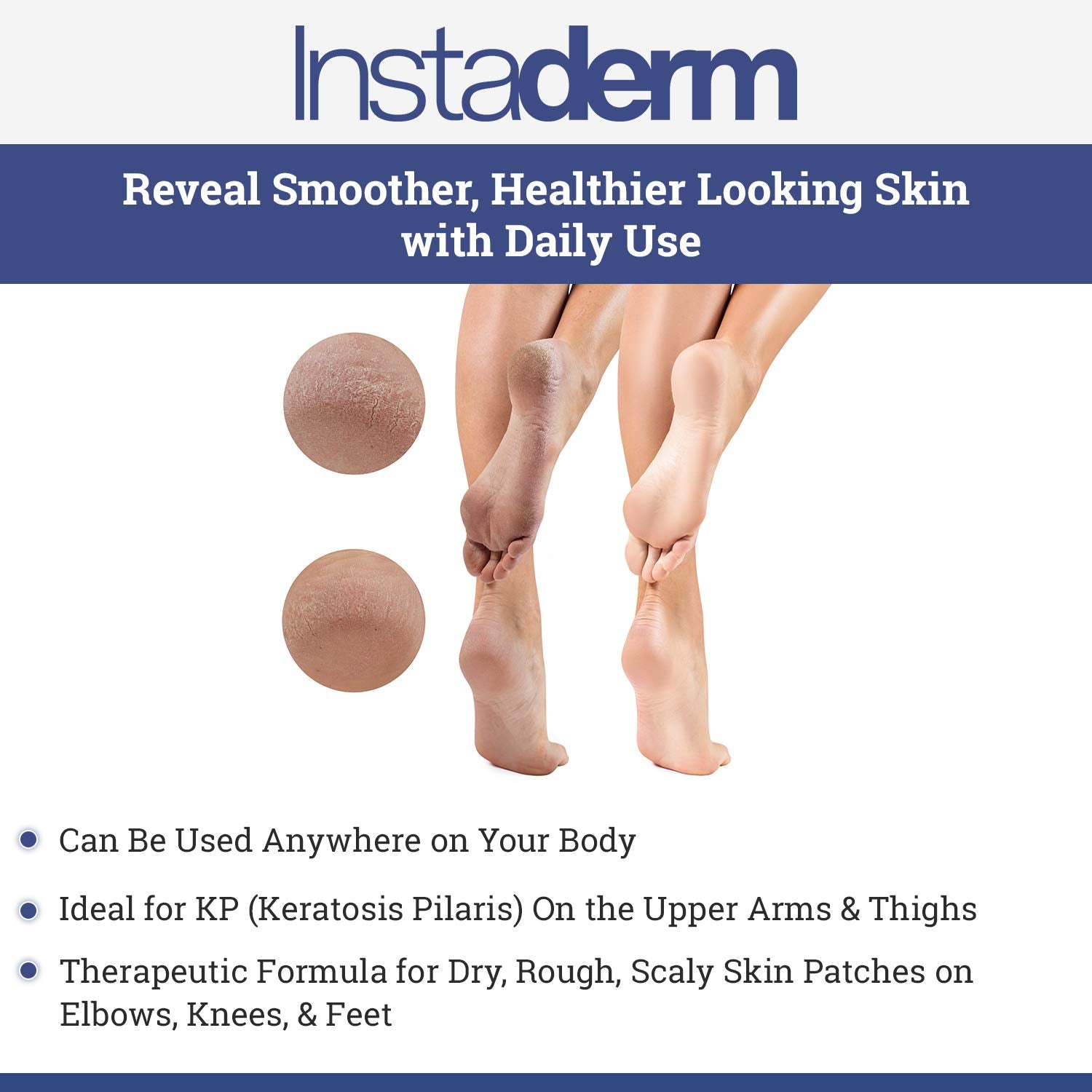 Instaderm Keratosis Pilaris Treatment- KP Bump Eraser. Smoothing Exfoliating Moisturizing Lotion for Rough, Dry, Flakey & Bumpy Skin Conditions with Lactic Acid, AHA. Smooth Skin Body Cream.