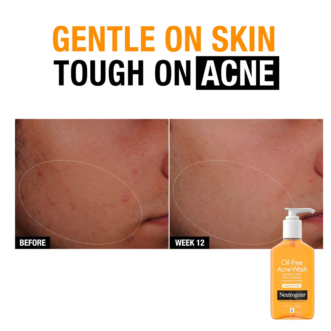 Neutrogena Oil-Free Acne Face Wash, Sensitive Skin Facial Cleanser with 2% Salicylic Acid Acne Treatment, Daily Fragrance Free Face Wash for Acne Prone Skin, 9.1 fl oz