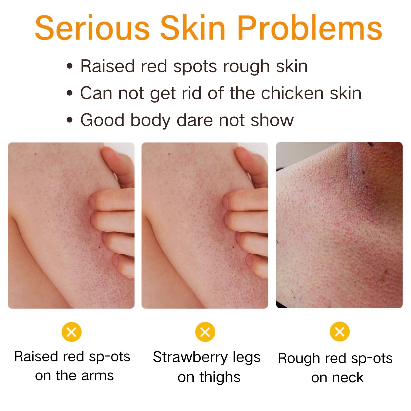 Strawberry Legs Treatment For Women - Bri-gh-tening Body Cream - Kera-tosis Pil-aris Treatment Lotion for Dry Skin - Strawberry Skin Treatment Body Moisturizer - Rough and Bumpy Skin Lotion