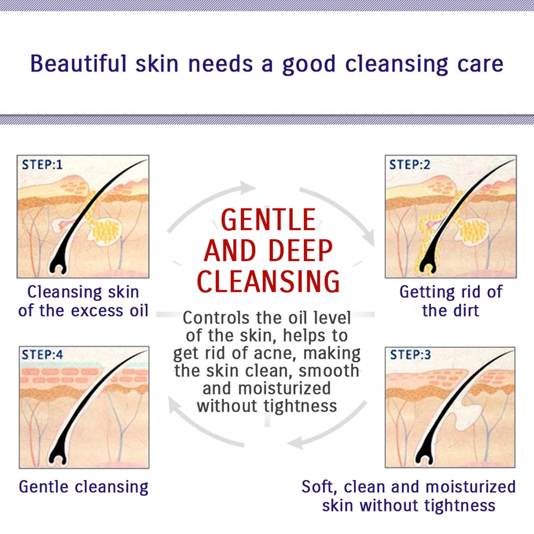 Skin Care Acne Face Treatment Removal Cream Spots Scar Blemish Mark 100g