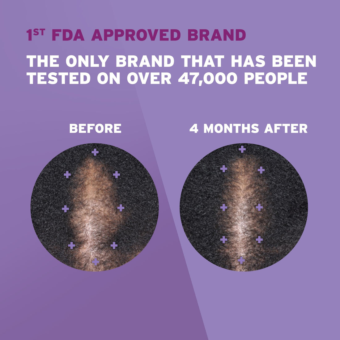 Rogaine for Women 5% Minoxidil Foam, Growth Treatment for Thinning & Hair Loss, Once-A-Day Unscented Topical Foam, Regrow Fuller Thicker Hair, Dermatologist Recommended, 4-Month Supply, 2 x 2.11 oz