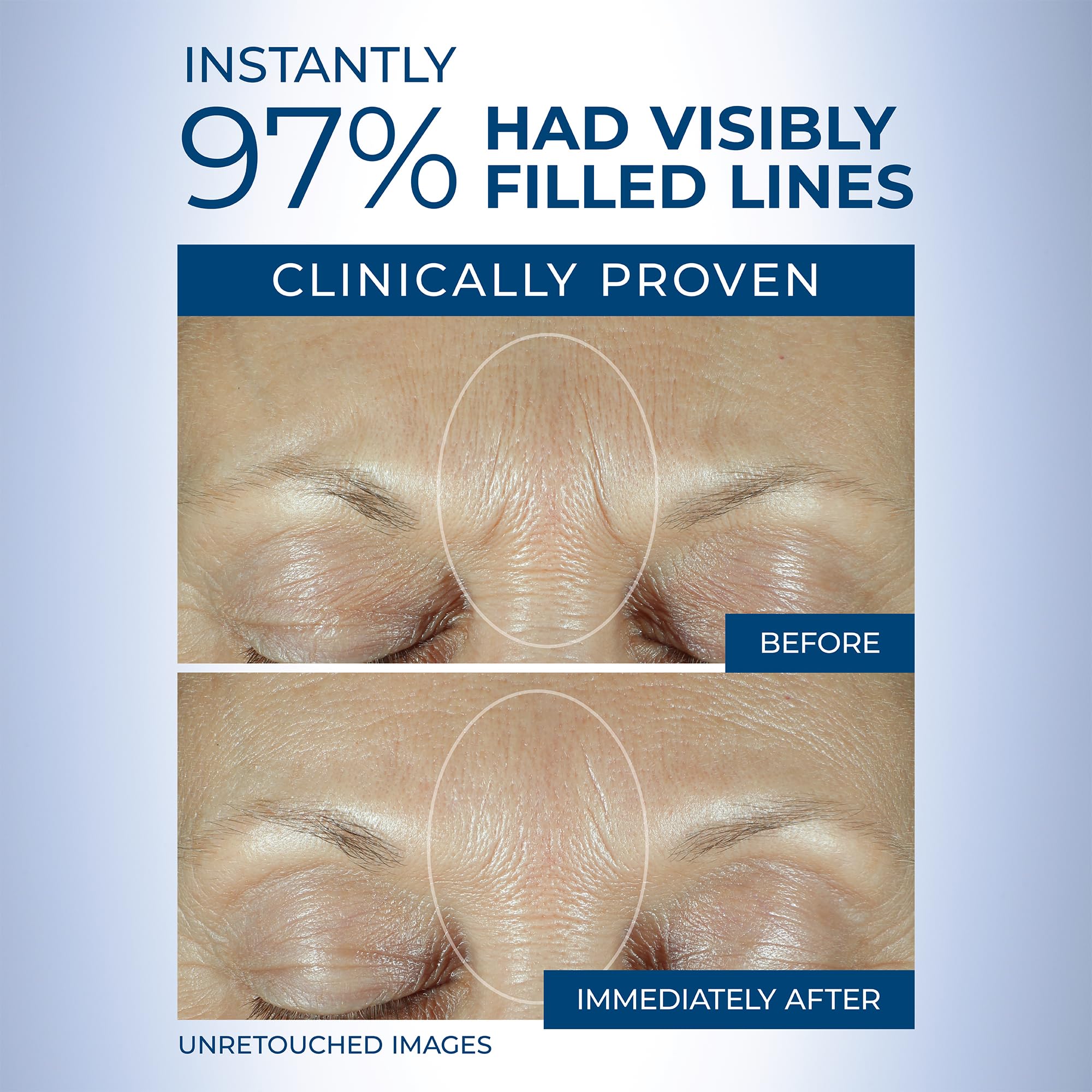 RoC Derm Correxion Fill + Treat Advanced Retinol Serum, Wrinkle Filler Treatment with Hyaluronic Acid for Crow's Feet, 11 Wrinkles, & Laugh Lines, (.5 fl oz) with Retinol Packette (Packaging May Vary)