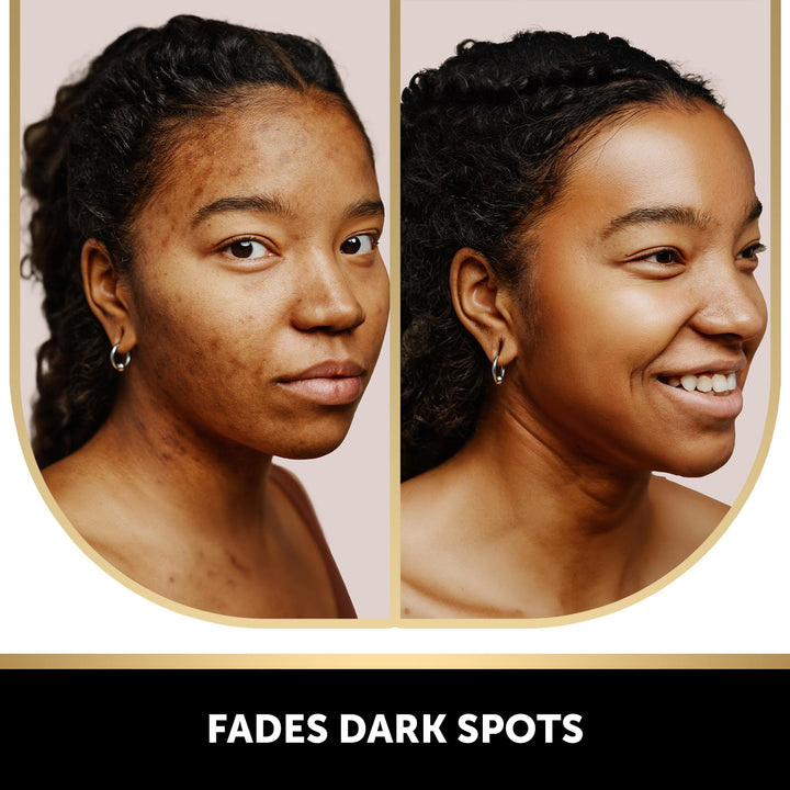 VALITIC 2 Pack Kojic Acid Dark Spot Corrector Soap Bars with Vitamin C, Retinol, Collagen, Turmeric - Original Japanese Complex - Hyaluronic Acid Bundle with 2 Black Exfoliating Gloves for Body Scrub