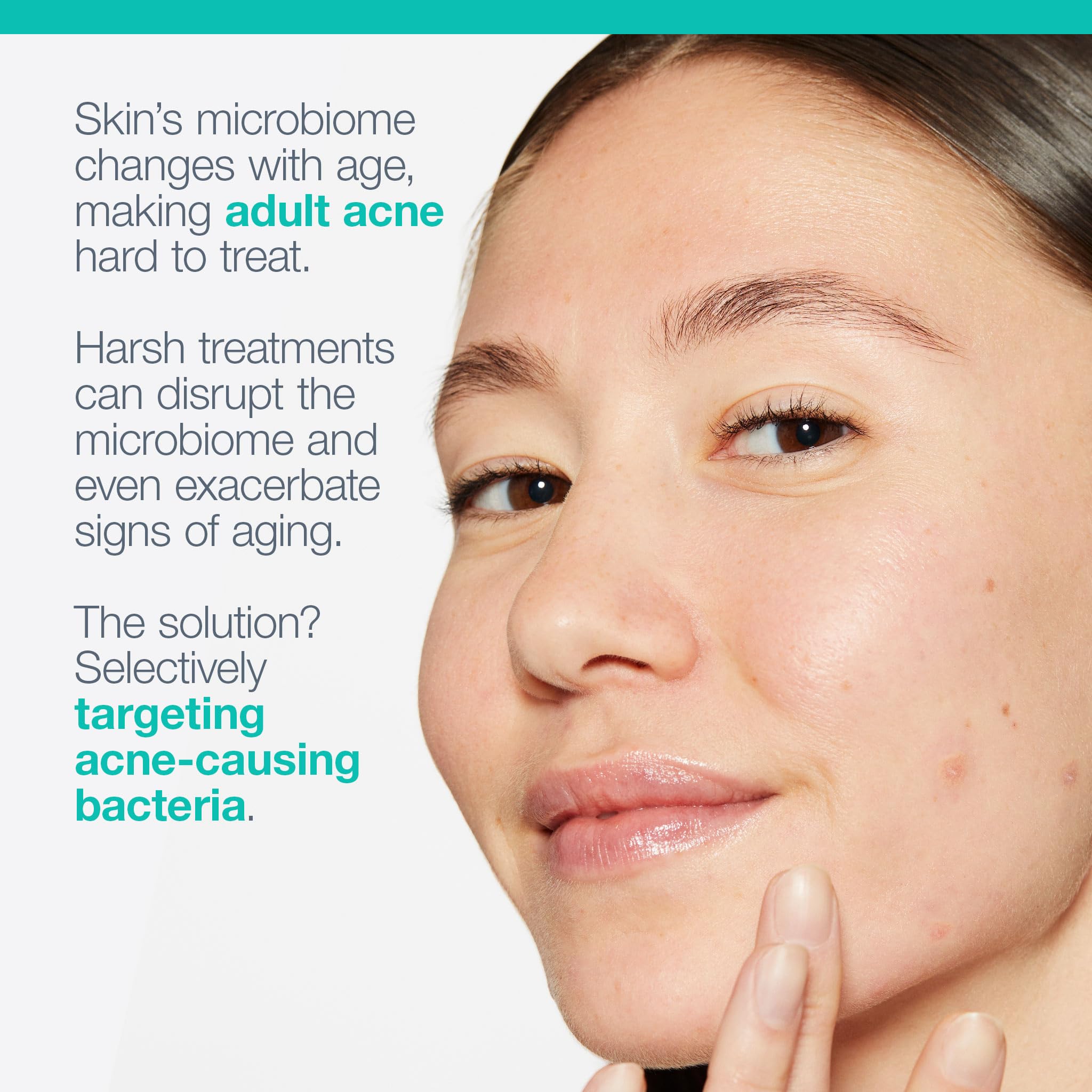 Dermalogica Acne Biotic Face Moisturizer, Lightweight Daily Lotion - Helps with Aging Skin and Prevents Breakouts, 1.7 fl oz