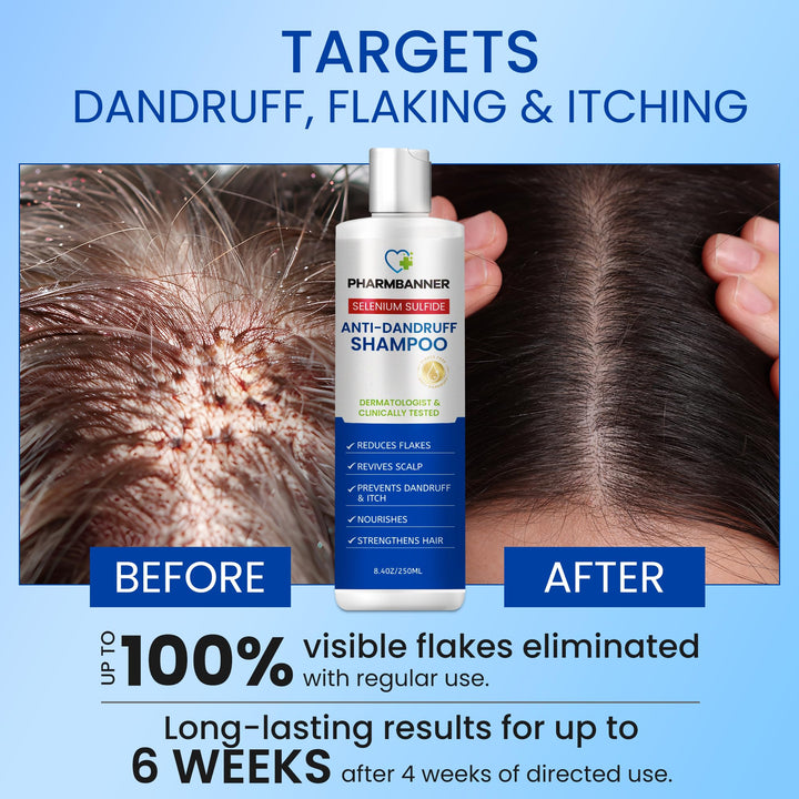 PHARMBANNER Anti-Dandruff Shampoo with Selenium Sulfide: For Flaky Scalp, Itching & Seborrheic Dermatitis Relief - Menthol & Lavender Oil - Moisturizing, Color Safe, Gentle for All Hair Types - 8.4oz