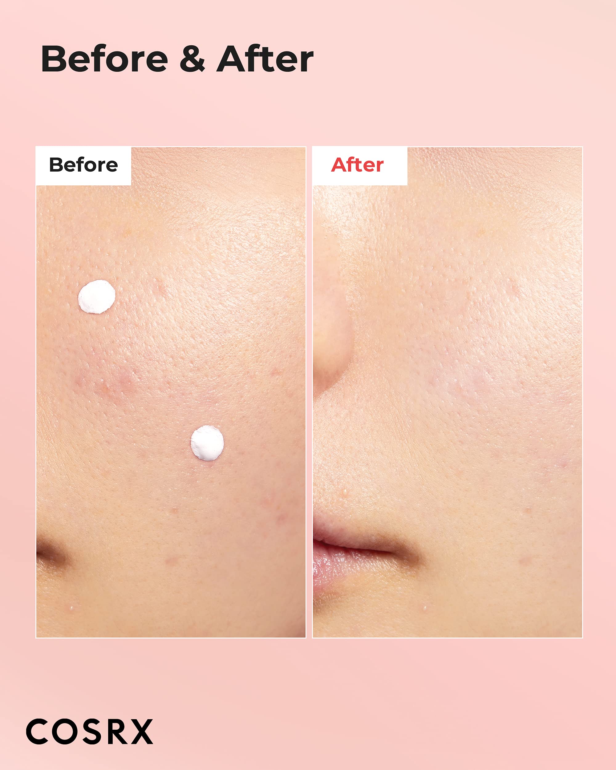 COSRX Acne Blemish Spot Drying Lotion 1.01 fl. oz / 30ml Dry and Reduce Blemish Spot, Pimple, Whitehead, Spot Treatment, Korean Skin Care