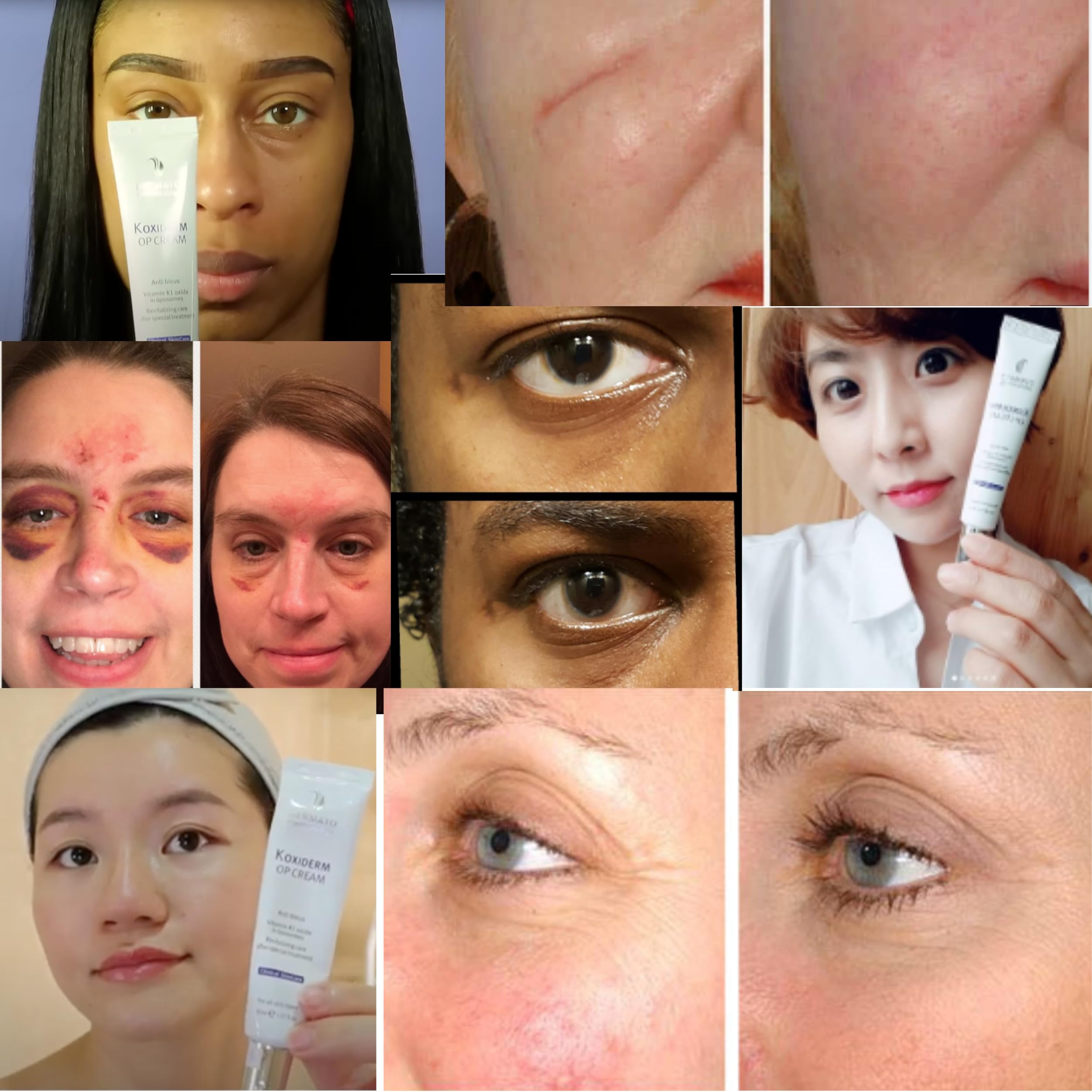 Vitamin K1 Cream, Minimizing Appearance of Scars, Dark Eye Circles, Bruises, Varicose Veins, Purpura and Redness 1.01Oz by dermato