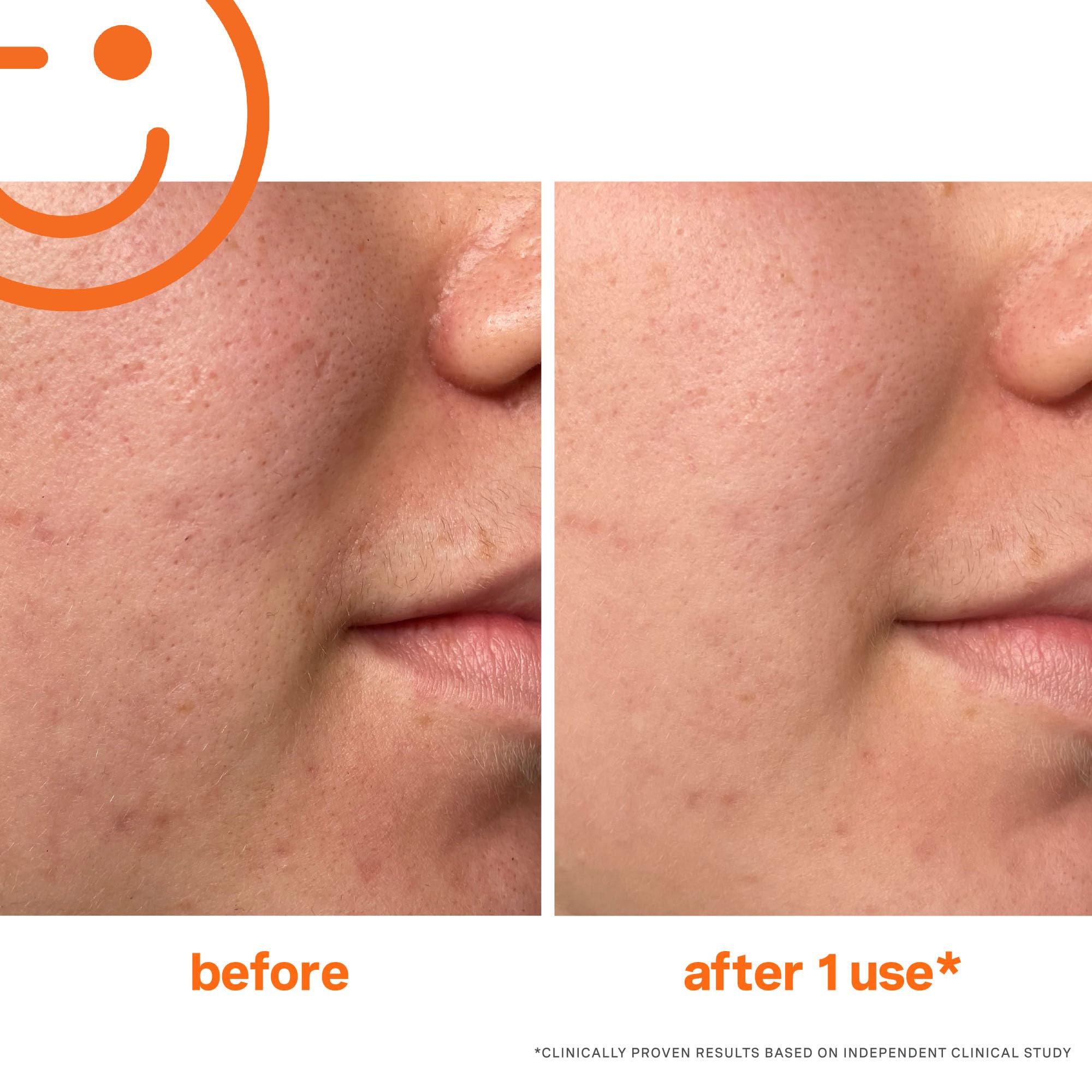 Kate Somerville ExfoliKate Intensive Exfoliating Treatment – Salicylic Acid and Lactic Acid Super Facial Scrub Improves Texture and Pores, 2 Fl Oz