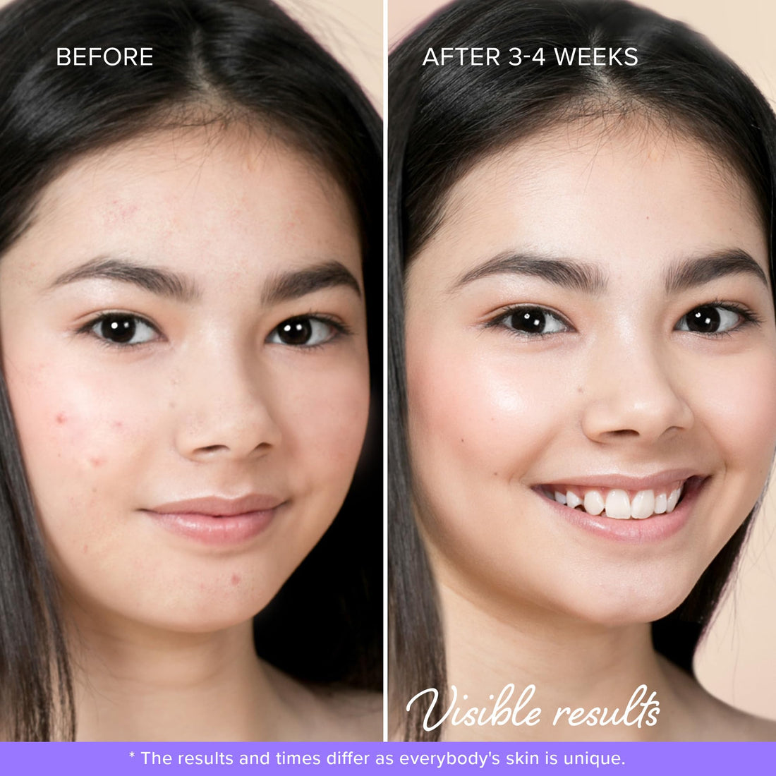 MAREE Star Pimple Patches for Face 2 PACK - Acne Patches - Natural Green Algae Extract & Tea Tree Oil - Hydrocolloid Stars Cute Zit Stickers, Parches Para Acne - Marine Collagen Blemish Pimple