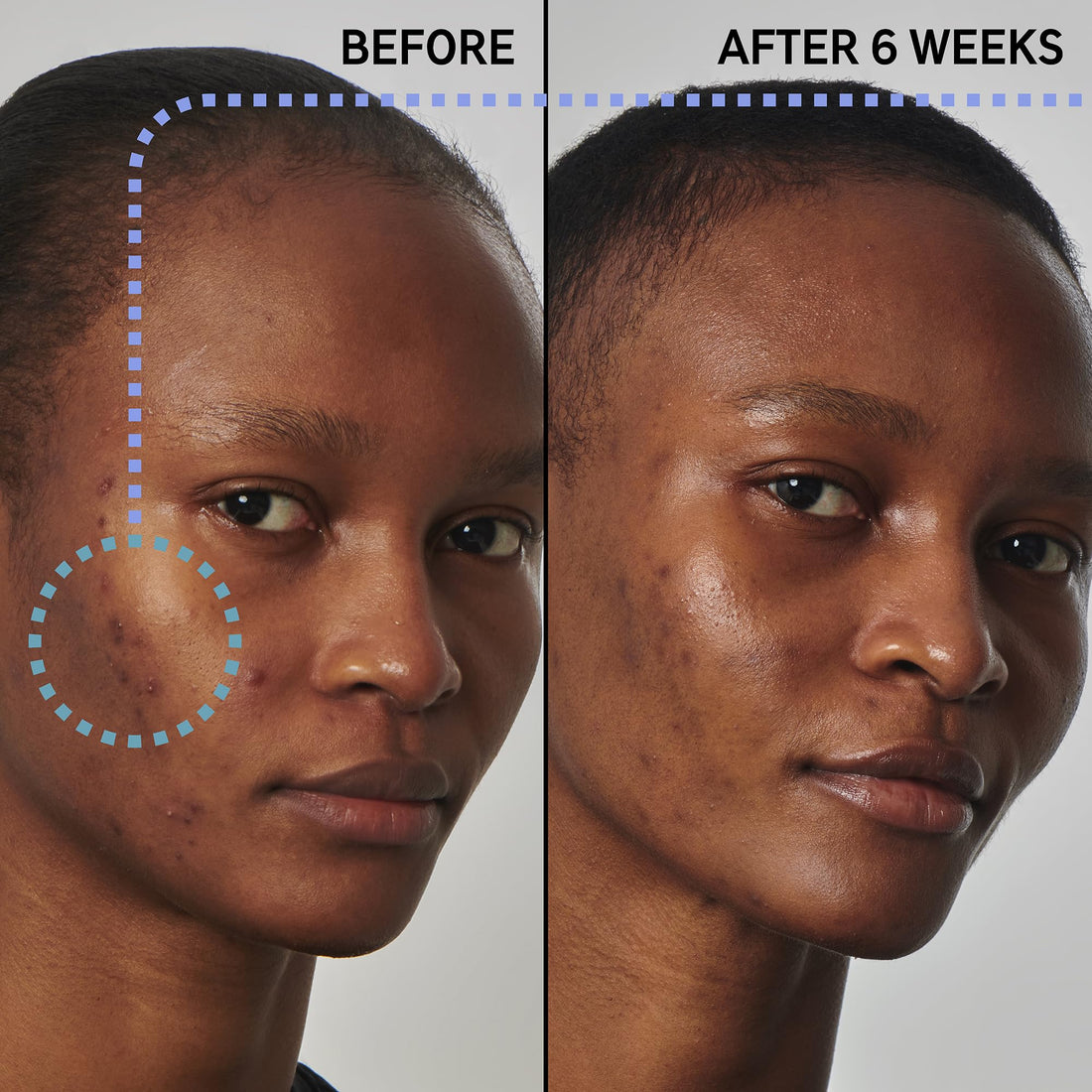 The INKEY List SuperSolutions Niacinamide 20% Serum, Helps with Healthy-Looking Skin Texture, Pores and Balancing Excess Oil, Skin Barrier Protection 1.01 fl oz