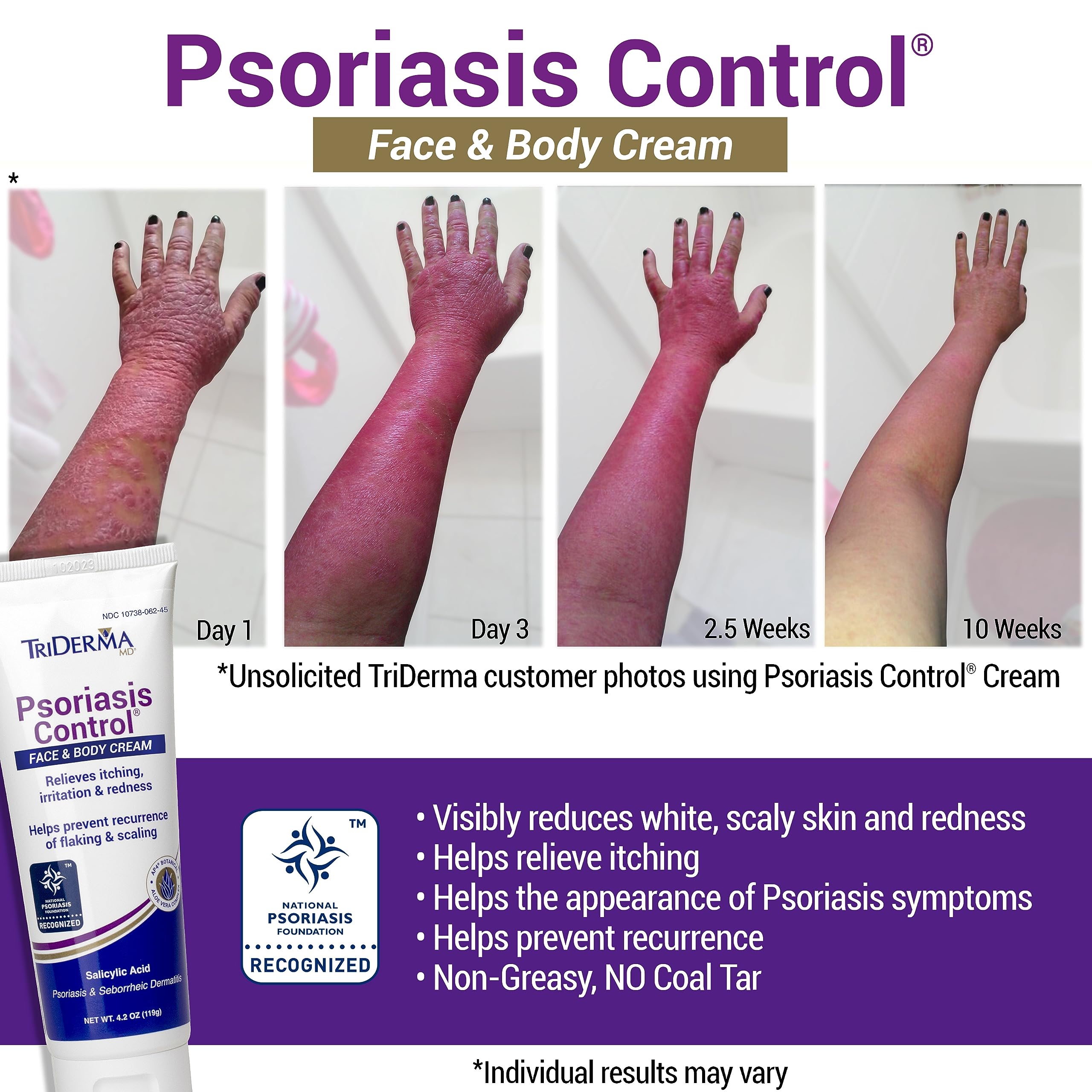 TriDerma Psoriasis Control Face and Body Cream, 4.2 Ounces
