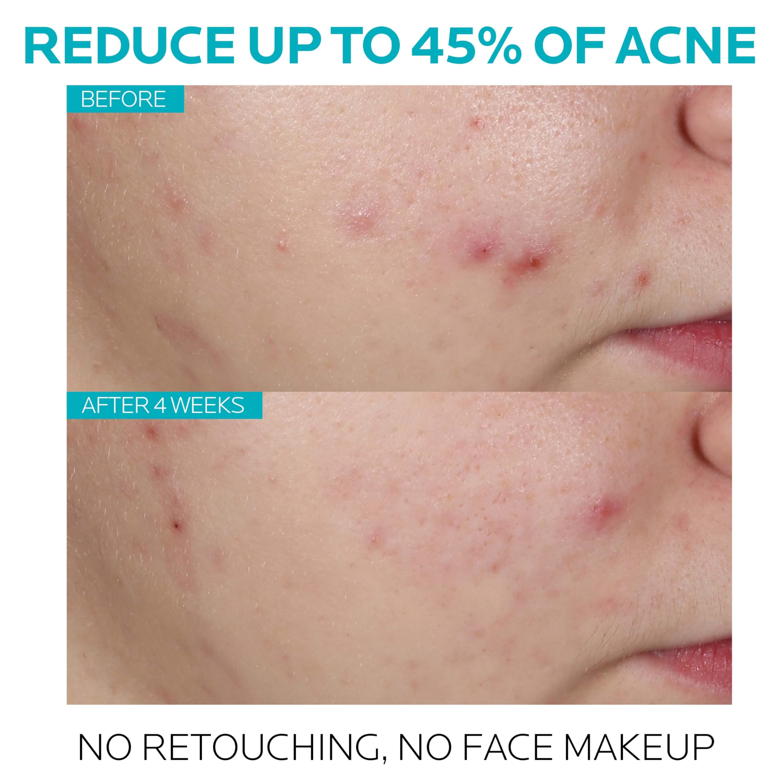 La Roche-Posay Effaclar Salicylic Acid Treatment to Minimize Pores, Clear Acne Blemishes and Post Acne Marks