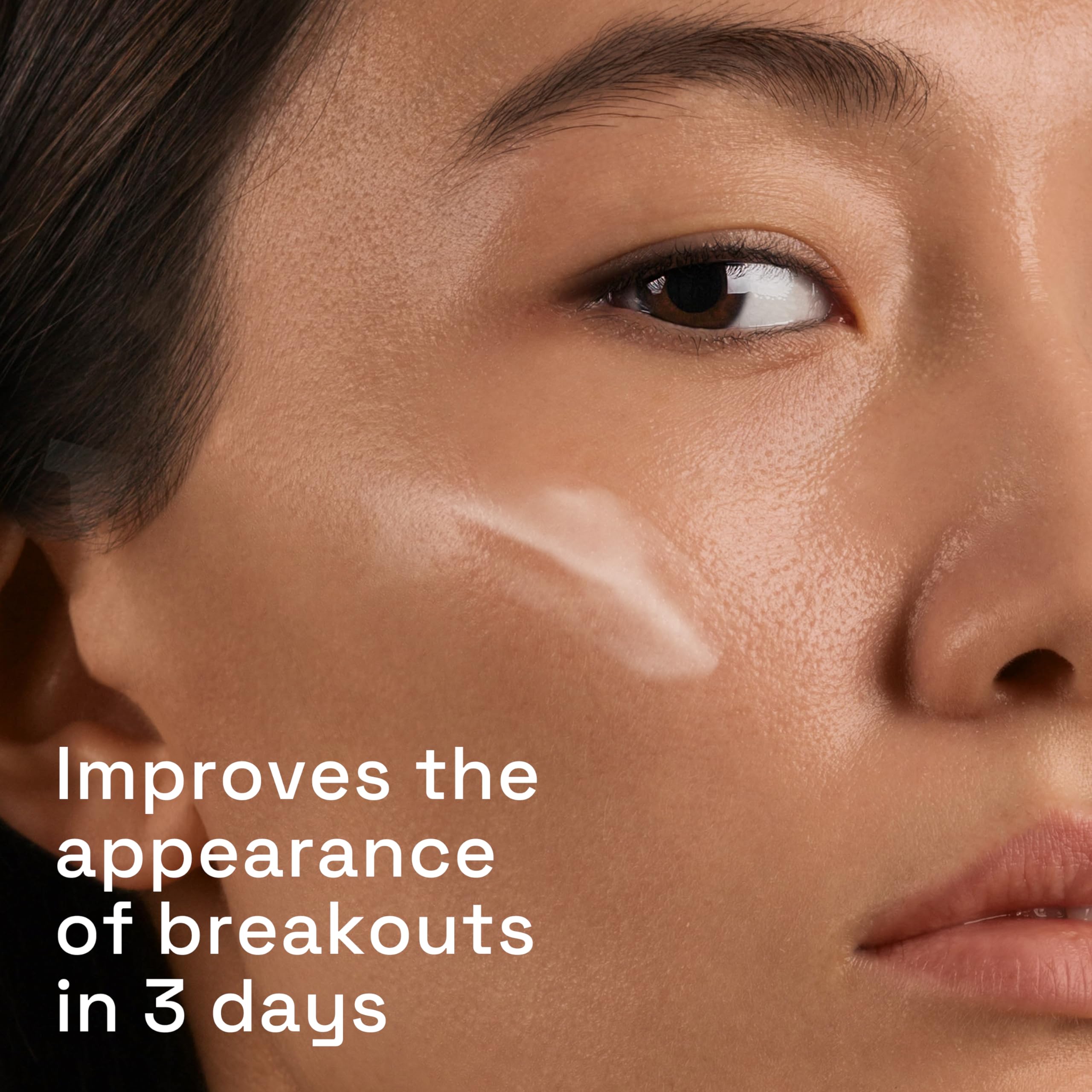 Cetaphil Gentle Clear Triple-Action Acne Treatment Serum with Salicylic Acid, Treats and Prevents Acne, Great for Post-Acne Marks, for All Skin Types, 1oz