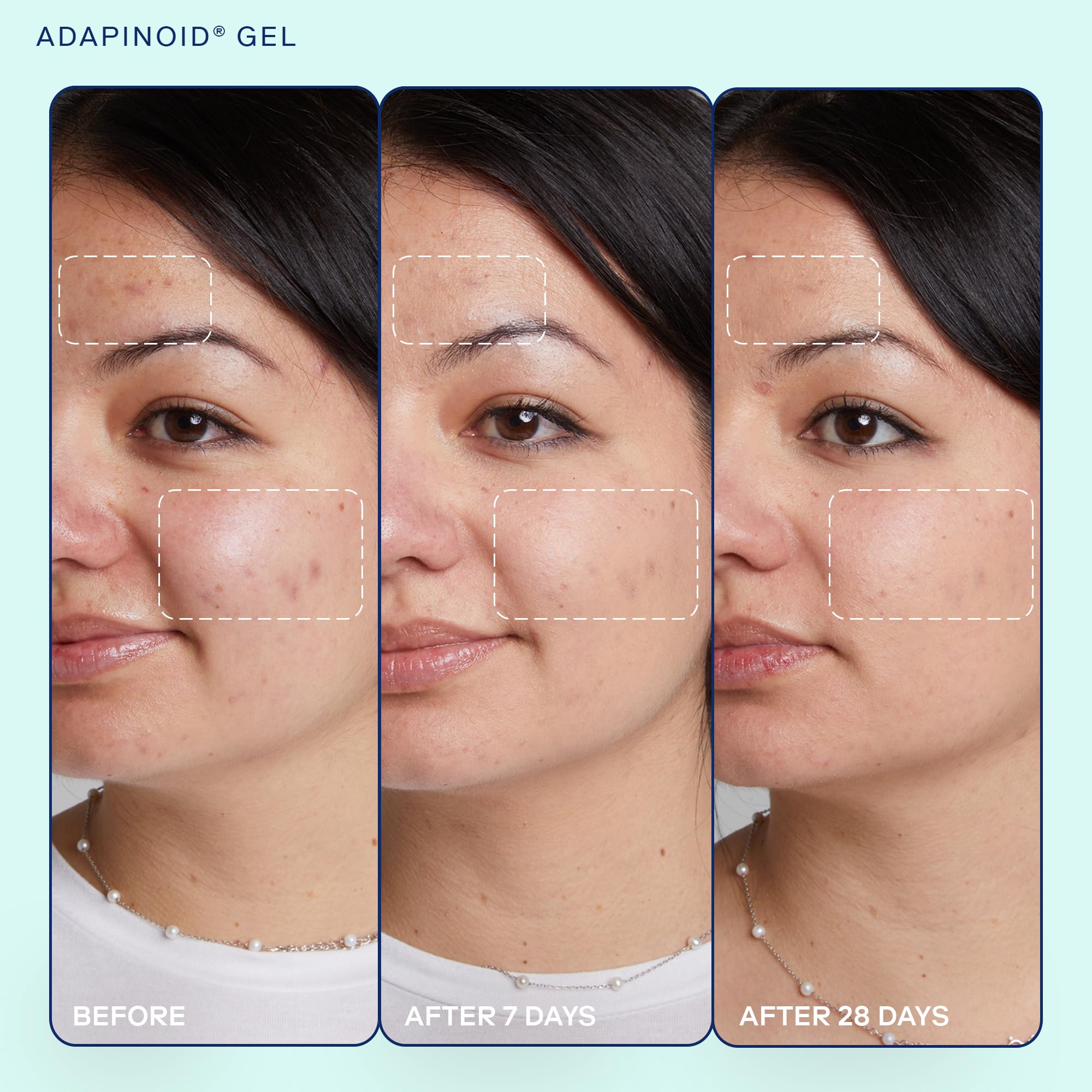 Skinfix Acne+ Adapinoid® Gel: Resurface + Clear Acne-Prone Skin Without Irritation, While Maintaining a Healthy-Looking Barrier, 1 Fl Oz