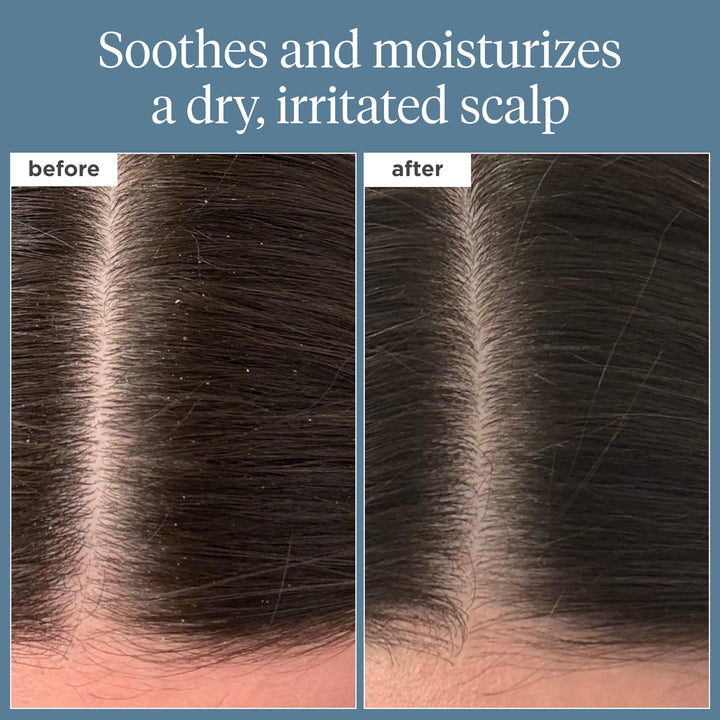 Briogeo Scalp Revival Rosemary Pre-Wash Oil, Hair and Scalp, Dry Scalp Treatment for Stronger and Longer Hair, Soothe Dry Scalp, Lipids and Vitamins, Deep Moisture, Vegan, Cruelty-Free, 3.4 fl oz