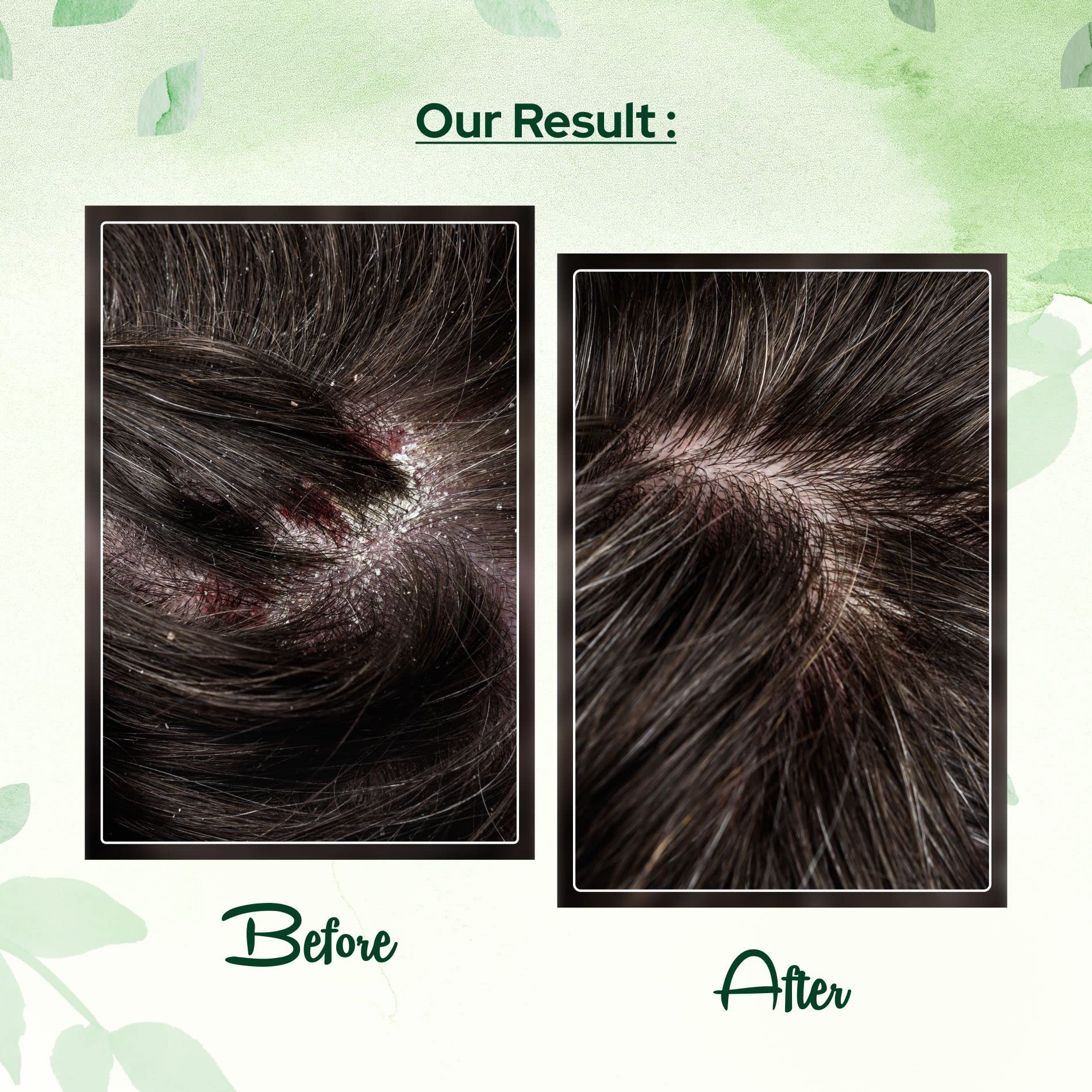 Cosalic Coal Tar and Salicylic Acid Solution/with Salicylic Acid for Dry Scalp Itch Relief Dandruff Free Shampoo/for Psoriasis & Seborrheic Dermatitis - Instant Result - 6.76 Fl Oz (Pack of 1)