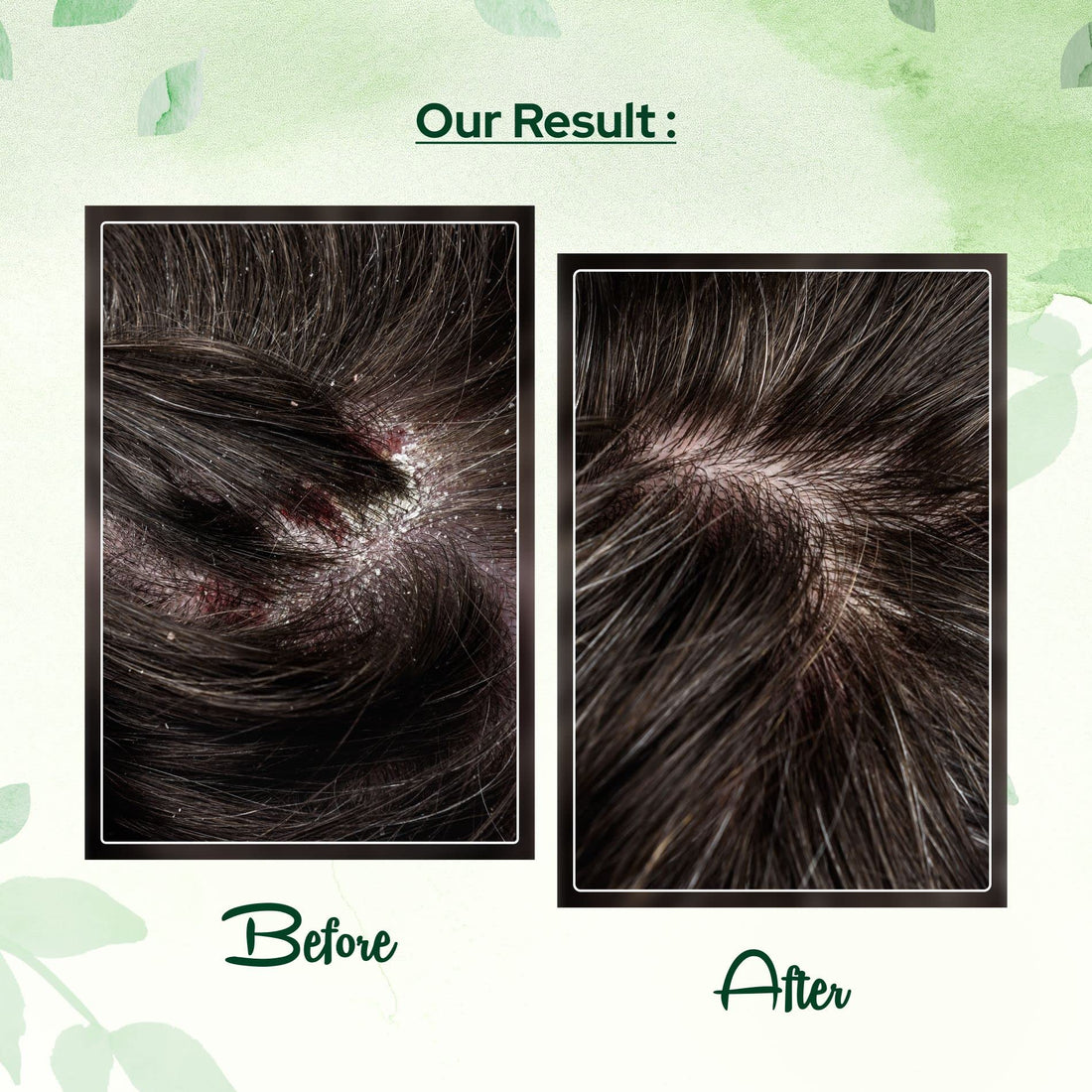 Cosalic Coal Tar and Salicylic Acid Solution/with Salicylic Acid for Dry Scalp Itch Relief Dandruff Free Shampoo/for Psoriasis & Seborrheic Dermatitis - Instant Result - 6.76 Fl Oz (Pack of 1)