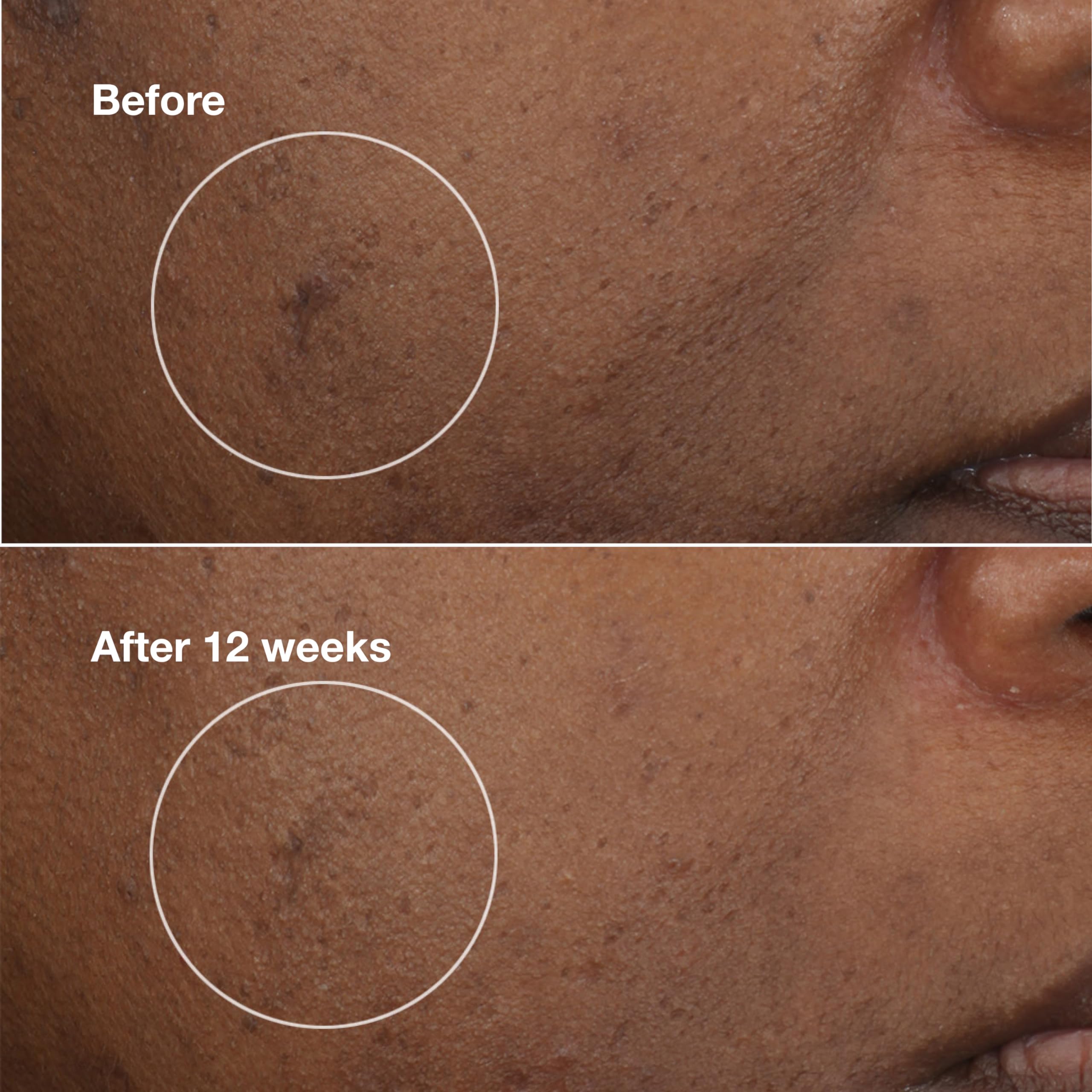 Clinique Even Better Clinical Brightening Moisturizer With Salicylic Acid, Glucosamine + Vitamin C | Hydrating + Dark Spot Reducing, 0.5 Ounce