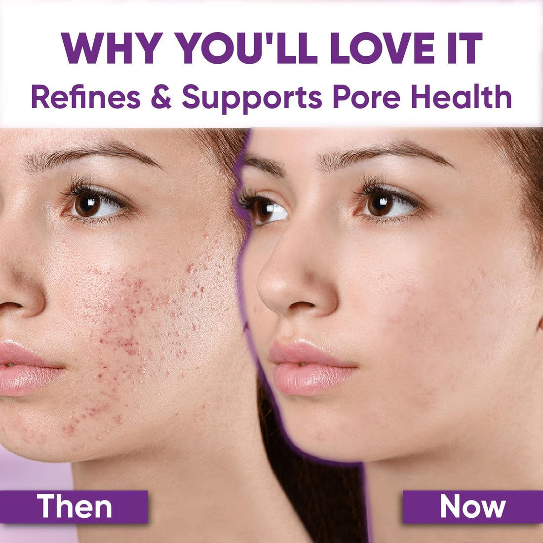 AOBBIY Azelaic Acid 10% Facial Cream: Redness Relief for Face, Redness Reducing Skin Care, Prevent Acne Breakouts, Balance Excess Sebum, Ease Pimple Clarify Skin Soothe Irritation,1 oz