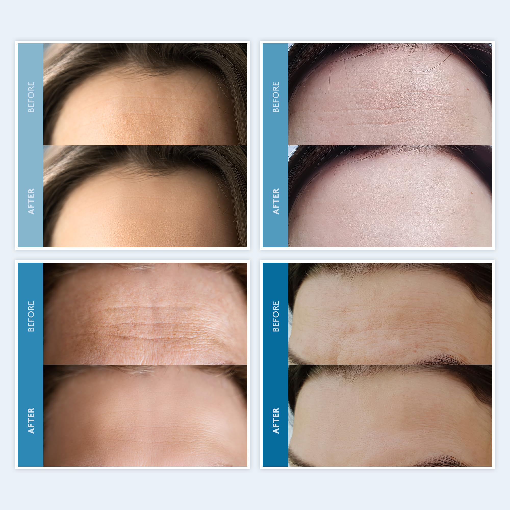 Dersie Silicone Forehead Wrinkle Patches: Reusable Silicone Anti Wrinkle Patches - Forehead Wrinkles Treatment - Overnight Use for Best Results - 3 Patches