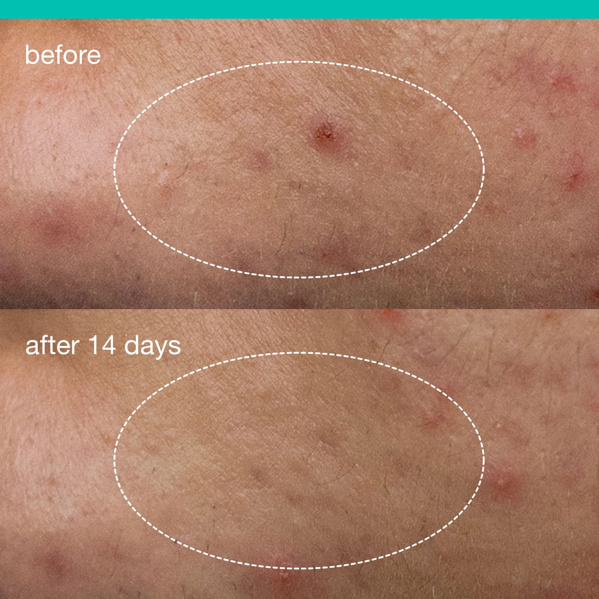 Dermalogica Deep Acne Liquid Patch, Sulfur Acne Treatment with Niacinamide, Invisible Spot Treatment for Blemish-Prone Skin – 0.5 fl oz