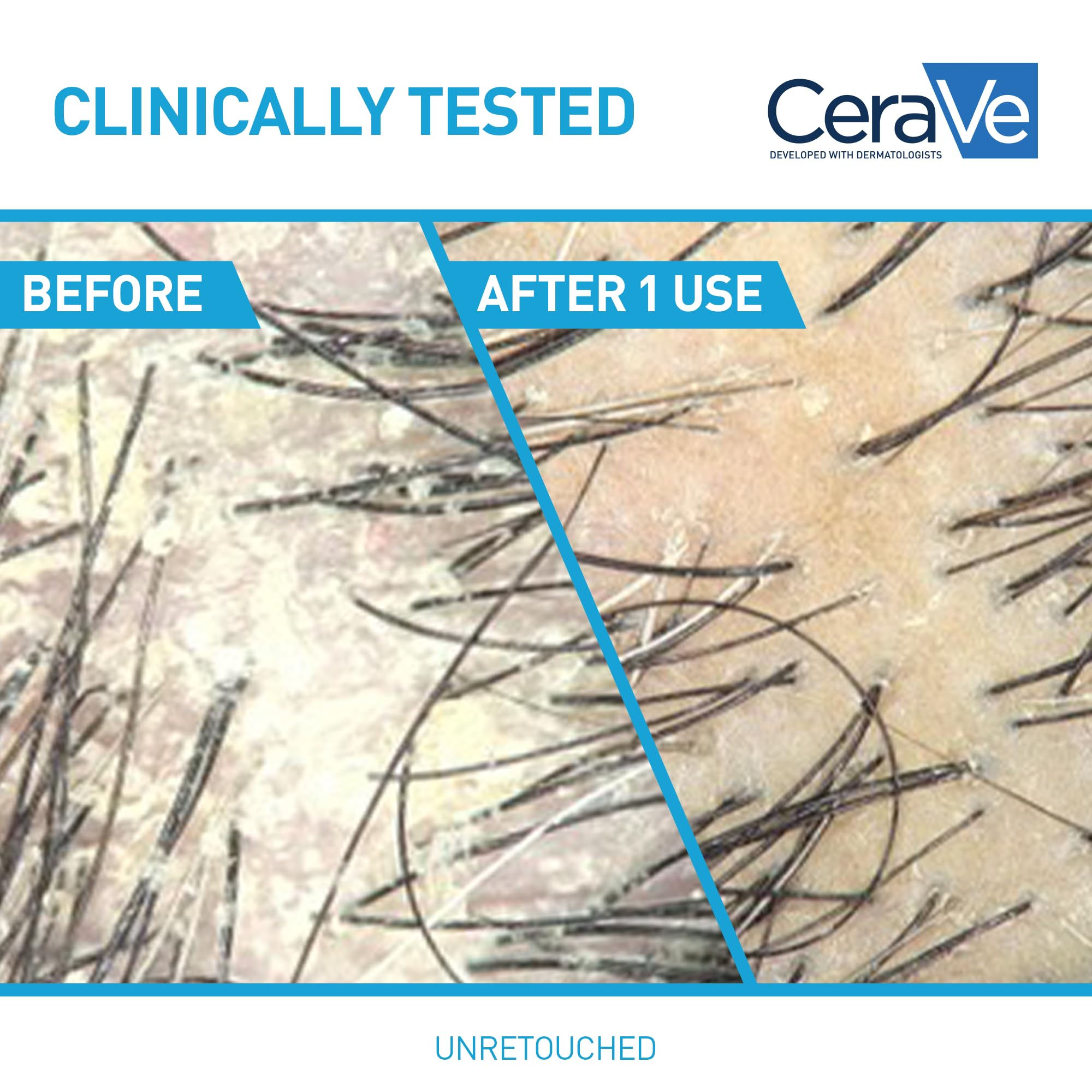 CeraVe Hydrating Anti Dandruff Conditioner, 0.5% Pyrithione Zinc Dandruff Treatment With Ceramides, Hyaluronic Acid & Niacinamide, Helps Eliminate Flakes & Reduce Itchy Scalp, Sulfate Free Conditioner