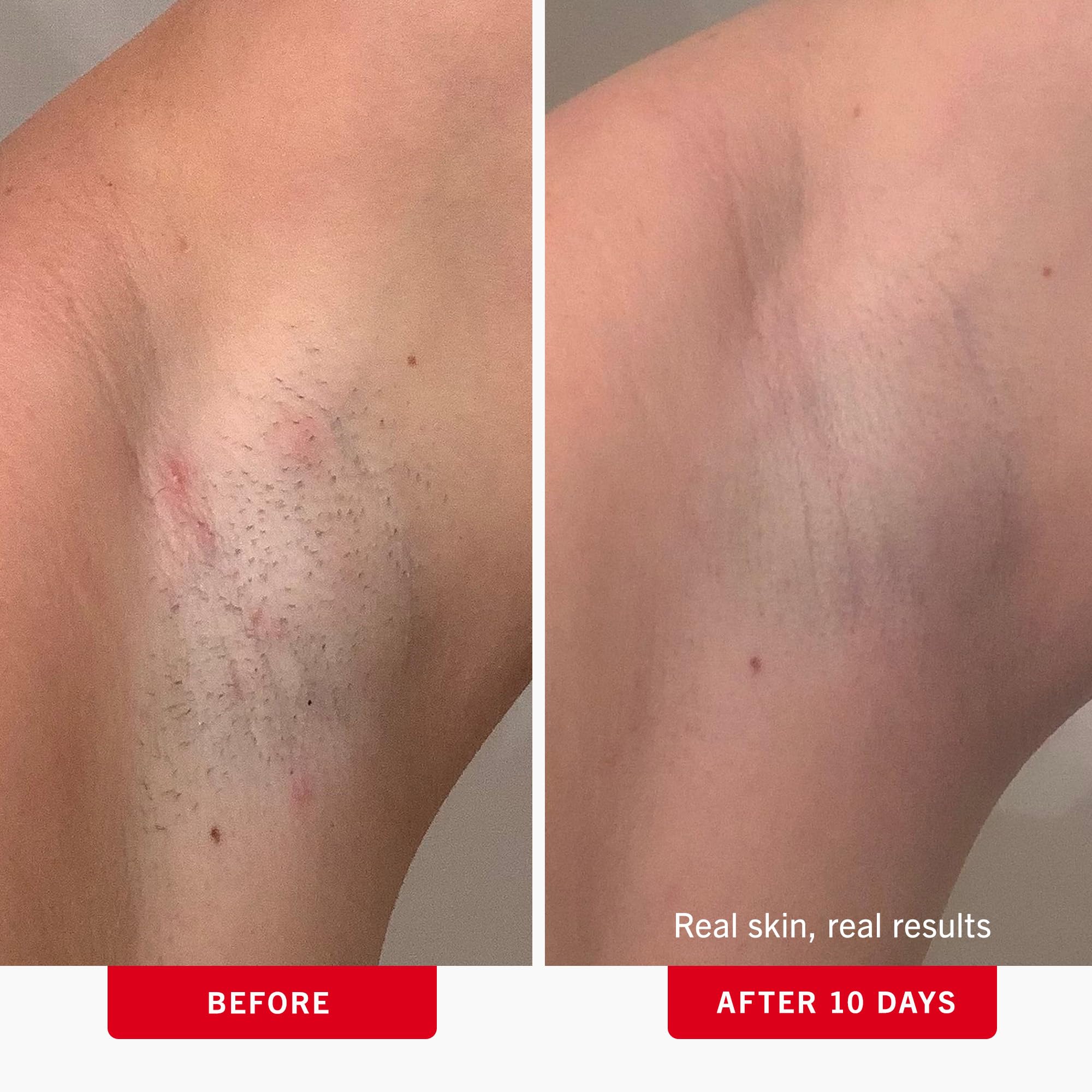 First Aid Beauty - Ingrown Hair Pads with BHA + AHA - Aftershave Treatment Pads to Help Prevent Razor Bumps for Men & Women - Exfoliate Underarms & Bikini Area - Compostable for Daily Use - 60 Pads